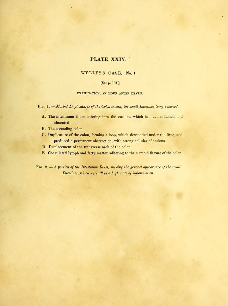 WYLLEY'S CASE, No. 1. [See p. 101.] EXAMINATION, AN HOUR AFTER DEATH. Fig. 1. — Morbid DupUcatures of the Colon in situ, the small Intestines being removed. A. The intestinum ilium entering into the caecum, which is much inflamed and ulcerated. B. The ascending colon. C. Duplicature of the colon, forming a loop, which descended under the liver, and produced a permanent obstruction, with strong cellular adhesions. D. Displacement of the transverse arch of the colon. E. Coagulated lymph and fatty matter adhering to the sigmoid flexure of the colon. Fig. 2. — A portion of the Intestinum Ilium, shewing the general appearance of the small Intestines, which were all in a high state of inflammation.