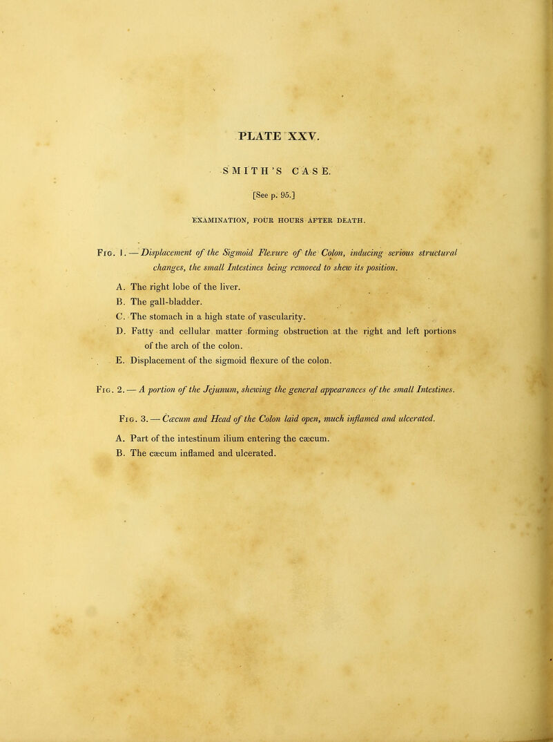 SMITH'S CASE. [See p. 95.] Examination, four hours after death. Fig. I.—Displacement of the Sigmoid Flexure of the Colon, inducing serious structural changes, the small Intestines being removed to shew its position. A. The right lobe of the liver. B. The gall-bladder. C. The stomach in a high state of vascularity. , D. Fatty and cellular matter forming obstruction at the right and left portions of the arch of the colon. E. Displacement of the sigmoid flexure of the colon. Fig. 2. — A portion of the Jejunum, shewing the general appearances of the small Intestines. Fig. 3. — CcEcum and Head of the Colon laid open, much inflamed and ulcerated. A. Part of the intestinum ilium entering the ceecum. B. The caecum inflamed and ulcerated.