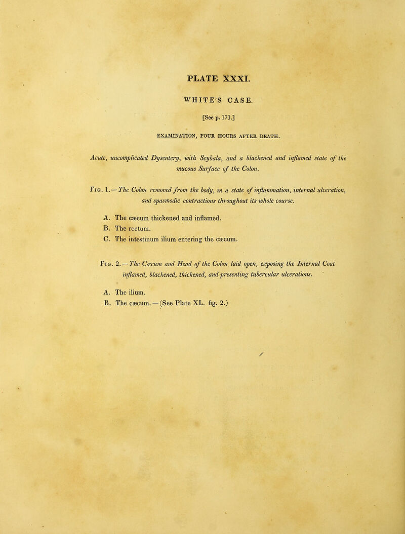 WHITE'S CASE. [See p. 171.] EXAMINATION, FOUR HOURS AFTER DEATH. Acute, uncomplicated Dysentery, with Scyhala, and a blackened and inflamed state of the mucous Surface of the Colon. Fig. 1. — The Colon removed from the body, in a state of inflammation, internal ulceration, and spasmodic contractions throughout its whole course. A. The caecum thickened and inflamed. B. The rectum. C. The intestinum ilium entering the caecum. Fig. 2. — The Ccecum and Head of the Colon laid open, exposing the Internal Coat inflamed, blackened, thickened, and presenting tubercular ulcerations. A. The ilium. B. The caecum. —(See Plate XL. fig. 2.)