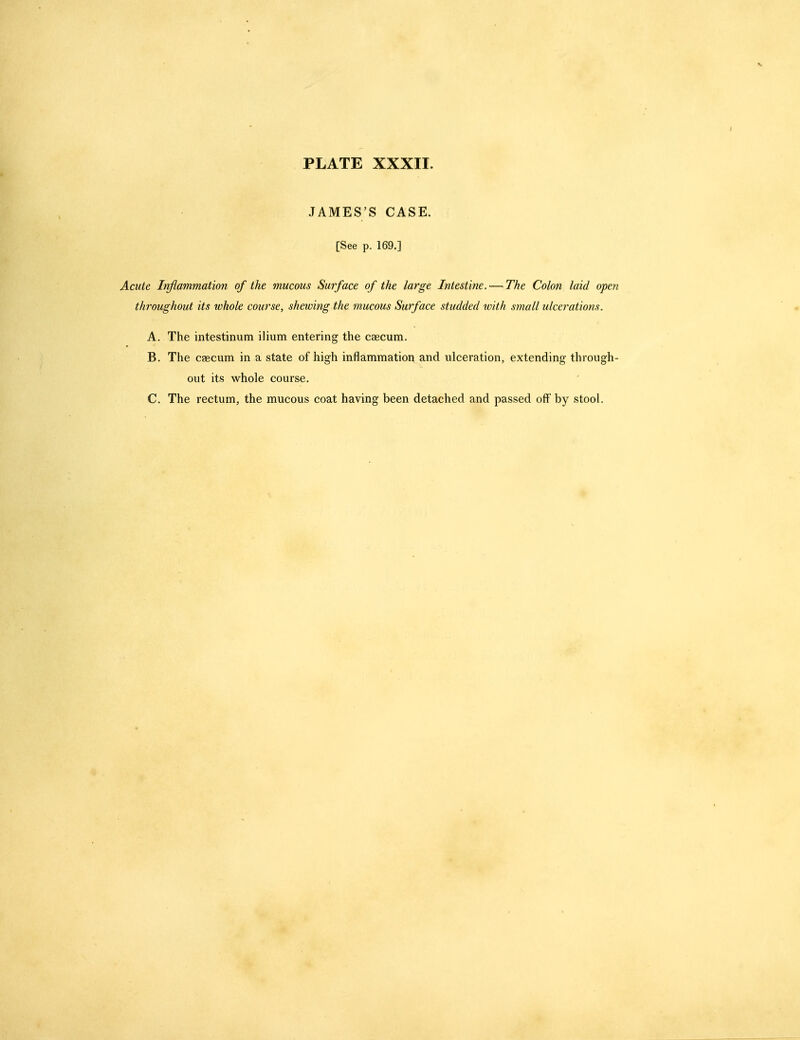 JAMES'S CASE. [See p. 169.] Acute Infiammation of the mucous Surface of the large Intestine. — The Colon laid open throughout its whole course, shewing the mucous Surface studded with small ulcerations. A. The intestinum ilium entering the caecum. B. The caecum in a state of high inflammation and ulceration, extending through- out its whole course. C. The rectum, the mucous coat having been detached and passed off by stool.