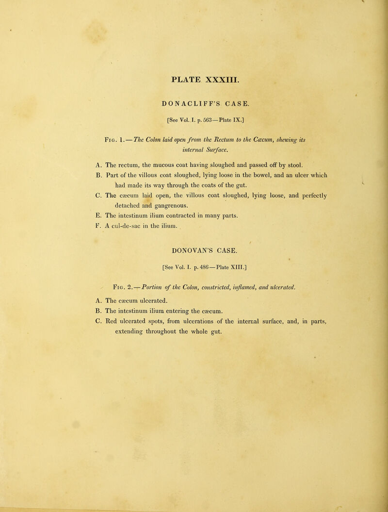 DONACLIFF'S CASE. [See Vol. .!. p. 563—Plate IX.] Fig. 1. — The Colon laid open from the Rectum to the Caecum, shewing its internal Surface. A. The rectum, the mucous coat having sloughed and passed off by stool. B. Part of the villous coat sloughed, lying loose in the bowel, and an ulcer which had made its way through the coats of the gut. C. The csecum laid open, the villous coat sloughed, lying loose, and perfectly detached and gangrenous. E. The intestinum ilium contracted in many parts. F. A cul-de-sac in the ilium. DONOVAN'S CASE. [See Vol. I. p. 486 —Plate XIII.] / Fig. 2. — Portion of the Colon, constricted, inflamed, and ulcerated. A. The caecum ulcerated. B. The intestinum ilium entering the caecum. C. Red ulcerated spots, from ulcerations of the internal surface, and, in parts, extending throughout the whole gut.