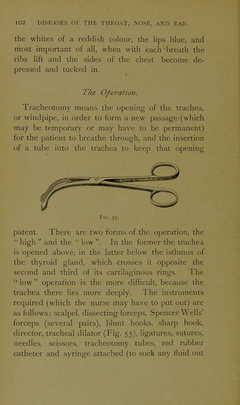 the whites of a reddish colour, the lips blue, and most important of all, when with each breath the ribs lift and the sides of the chest become de- pressed and tucked in. The Operation. Tracheotomy means the opening of the trachea, or windpipe, in order to form a new passage (which may be temporary or may have to be permanent) for the patient to breathe through, and the insertion of a tube into the trachea to keep that opening Fig. 55. patent. There are two forms of the operation, the “high” and the “ low”. In the former the trachea is opened above, in the latter below the isthmus of the thyroid gland, which crosses it opposite the second and third of its cartilaginous rings. The “ low ” operation is the more difficult, because the trachea there lies more deeply. The instruments required (which the nurse may have to put out) are as follows: scalpel, dissecting forceps, Spencer Wells’ forceps (several pairs), blunt hooks, sharp hook, director, tracheal dilator (Fig. 55), ligatures, sutures, needles, scissors, tracheotomy tubes, red rubber catheter and syringe attached (to suck any fluid out