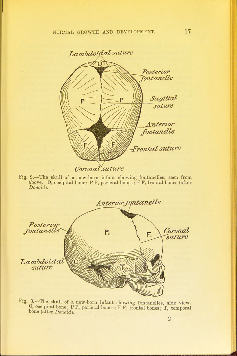 LambdoidaZ sutitre _Posterior ~fontanelle Sagittal ^suture Anterior JontaneUe -Frontal suture Coronal suture Fig. 2.—The skull of a new-born infant showing fontanelles, seen from above. 0, occipital bone; P P, parietal bones; F F, frontal bones (after Donald). Anteriorfqntanelle Posterior J'ontcLnelle LaTTihdoicictZ suture Coronal 'suture Fig. 3.—The skull of a new-bom infant showing fontanelles, side view. O, occipital bone; PP, parietal boues; F F, frontal bones; T, temporal bone (after Donald). 2