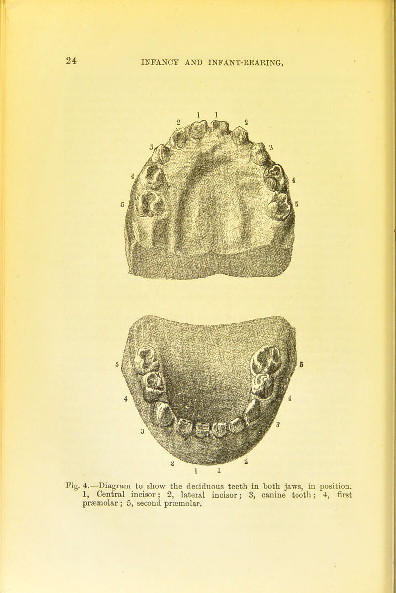 Fig. 4.—Diagram to show the deciduous teeth in both jaws, in position. 1, Central incisor; 2, lateral incisor; 3, canine tooth; 4, first prJEmolar; 5, second prasmolar.