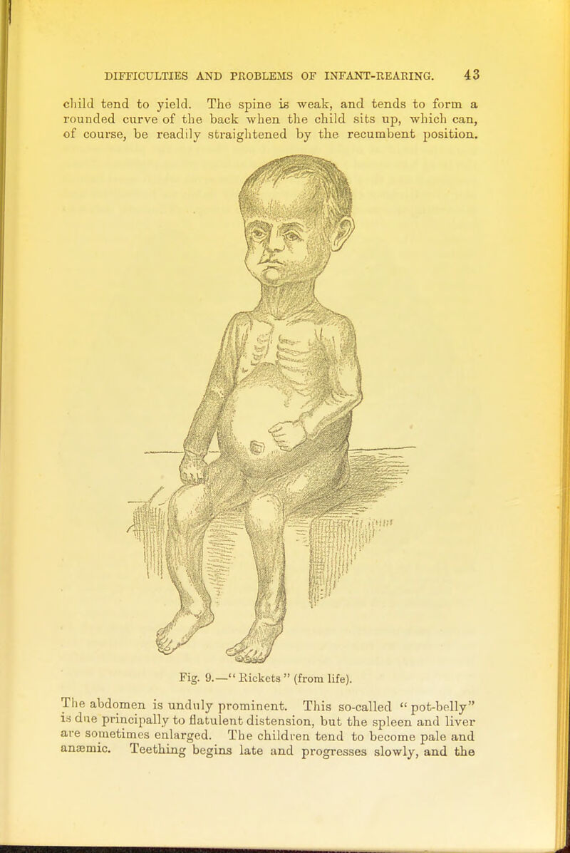 cliild tend to yield. The spine is weak, and tends to form a rounded curve of the back when tlie child sits up, which can, of course, be readily straightened by the recumbent position. Fig. 9.— Kickets (from life). Tlie abdomen is unduly prominent. This so-called pot-belly is due principally to flatulent distension, but the spleen and liver are sometimes enlarged. The children tend to become pale and anaemic. Teething begins late and progresses slowly, and the