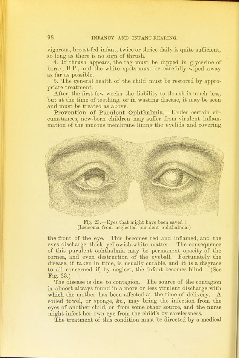 vigorous, breast fed infant, twice or thrice daily is quite sufficient, so long as there is no sign of thrush. 4. If thrush appears, the rag must be dipped in glycerine of borax, B.P., and the white spots must be carefully wiped away as far as possible. 5. The general health of the child must be restored by appro- priate treatment. After the first few weeks the liability to thrush is much less, but at the time of teething, or in wasting disease, it may be seen and must be treated as above. Prevention of Purulent Ophthalmia.—-Under certain cir- cumstances, new-born children may suffer from virulent inflam- mation of the mucous membrane lining the eyelids and covering Fig. 23.—Eyes that might have been saved ! (Leucoma from neglected jmrulent ophthalmia.) the front of the eye. This becomes red and inflamed, and the eyes discharge thick yellowish-white matter. The consequence of this purulent ophthalmia may be permanent opacity of the cornea, and even destruction of the eyeball. Fortunately the disease, if taken in time, is usually curable, and it is a disgrace to all concerned if, by neglect, the infant becomes blind. (See Fig. 23.) The disease is due to contagion. The source of the contagion is almost always found in a more or less virulent discharge with which the mother has been affected at the time of delivery. A soiled towel, or sponge, &c., may bring the infection from the eyes of another child, or from some other source, and the nurse might infect her own eye from the child's by carelessness. The treatment of this condition must be directed by a medical