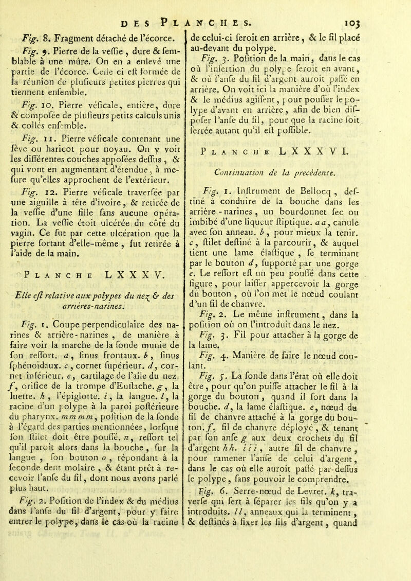 Flg. 8. Fragment détaché de l'écorce. Fig. y. Pierre de la veffie , dure & fem- blable à une mûre. On en a enlevé une partie de l'écorce. Celle ci eft formée de ïa réunion de plufieurs petites pierres qui tiennent enfemble. Fig. 10. Pierre véficaîe, entière, dure & compolee de plufieurs petits calculs unis & collés enfemble. Fig. ii. Pierre véficaîe contenant une fève ou haricot pour noyau. On y voit les différentes couches appofées deffus , & qui vont en augmentant d'étendue, à me- fure qu'elles approchent de l'extérieur. Fig. 12. Pierre véficaîe traverfée par une aiguille à tête d'ivoire, & retirée de la veffie d'une fille fans aucune opéra- tion. La veffie étoit ulcérée du coté du vagin. Ce fut par cette ulcération que la pierre fortant d'elle-même , fut retirée à l'aide de la main. Planche LXXXV. Elle ejl relative aux polypes du ne%_ & des arrières-narines. Fig. r. Coupe perpendiculaire des na- rines 6V arrière-narines , de manière à faire voir la marche de la fonde munie de fon reffort. a, fin us frontaux, b, finus fphénoïdaux. c , cornet fupérieur. d, cor- net inférieur. et cartilage de l'aile du nez. f, orifice de la trompe d'Euftache. g, la luette, h , Pépiglotte. i, la langue. I, la racine d'un polype à la paroi poftérieure du pharynx, mm m m, pofition de la fonde à l'égard des parties mentionnées, lorfque fon ftilet doit être pouffé, tz, reffort tel qu'il paroît alors dans la bouche , fur la langue , fon bouton o , répondant à la féconde dent molaire , & étant prêt à re- cevoir l'anfe du fil, dont nous avons parlé plus haut. Fig. 2. Pofition de l'index & du médius dans l'anfe du fil d'argent, pour y faire entier le polype, dans le cas où la racine de celui-ci feroit en arrière, & le fil placé au-devant du polype. Fig. 3. Pofition de la main, dans le cas où l'infertion du polyt e feroit en avant, & où l'anfe du fil d'argent auroit paffe en arrière. On voit ici la manière d'où l'index & le médius agiifent, j our pouffer le po- lype d'avant en arrière, afin de bien dif- pofer l'anfe du fil, pour que la racine foie ferrée autant qu'il elt poffible. Planche LXXXVI. Continuation de la précédente. Fig. 1. Infiniment de Bellocq , déf- inie à conduire de la bouche dans les arrière - narines , un bourdonnet fec ou imbibé d'une liqueur ftiptique. aa, canule avec fon anneau, b , pour mieux la tenir, c, ftilet deftiné à la parcourir, Se auquel tient une lame élaftique , fe terminant par le bouton d, fupporté par une gorge e. Le reffort eft un peu pouffé dans cette figure, pour laiffer appercevoir la gorge du bouton , où l'on met le nœud coulant d'un fil de chanvre. Fig. 2. Le même infirument, dans la pofition où on l'introduit dans le nez. Fig. 3. Fil pour attacher à la gorge de la lame. Fig. 4,. Manière de faire le nœud cou- lant. Fig. y. La fonde dans l'état où elle doit être , pour qu'on puiffe attacher le fil à la gorge du bouton , quand il fort dans la bouche, d, la lame élaftique. e, nœud du fil de chanvre attaché à la gorge du bou- ton./*, fil de chanvre déployé, Se tenant par fon anfe g aux deux crochets du fil d'argent h h. iii, autre fil de chanvre, pour ramener l'anfe de celui d'argent, dans le cas où elle auroit pallé par-deffus le polype , fans pouvoir le comprendre. Fig. 6. Serre-nœud de Levret. k> tra- verfe qui fert à féparer les fils qu'on y a introduits. //, anneaux qui la terminent, Se defiinés à fixer les fils d'argent, quand