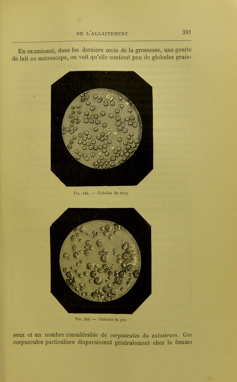 En examinant, dans les derniers mois de la grossesse, une goutte de lait au microscope, on voit qu'elle contient peu de globules grais- FiG. 245. — Globules de sang. FiG. 246. — Globules de pus. seux et un nombre considérable de corpuscules du colostrum. Ces corpuscules particuliers disparaissent généralement chez la femme