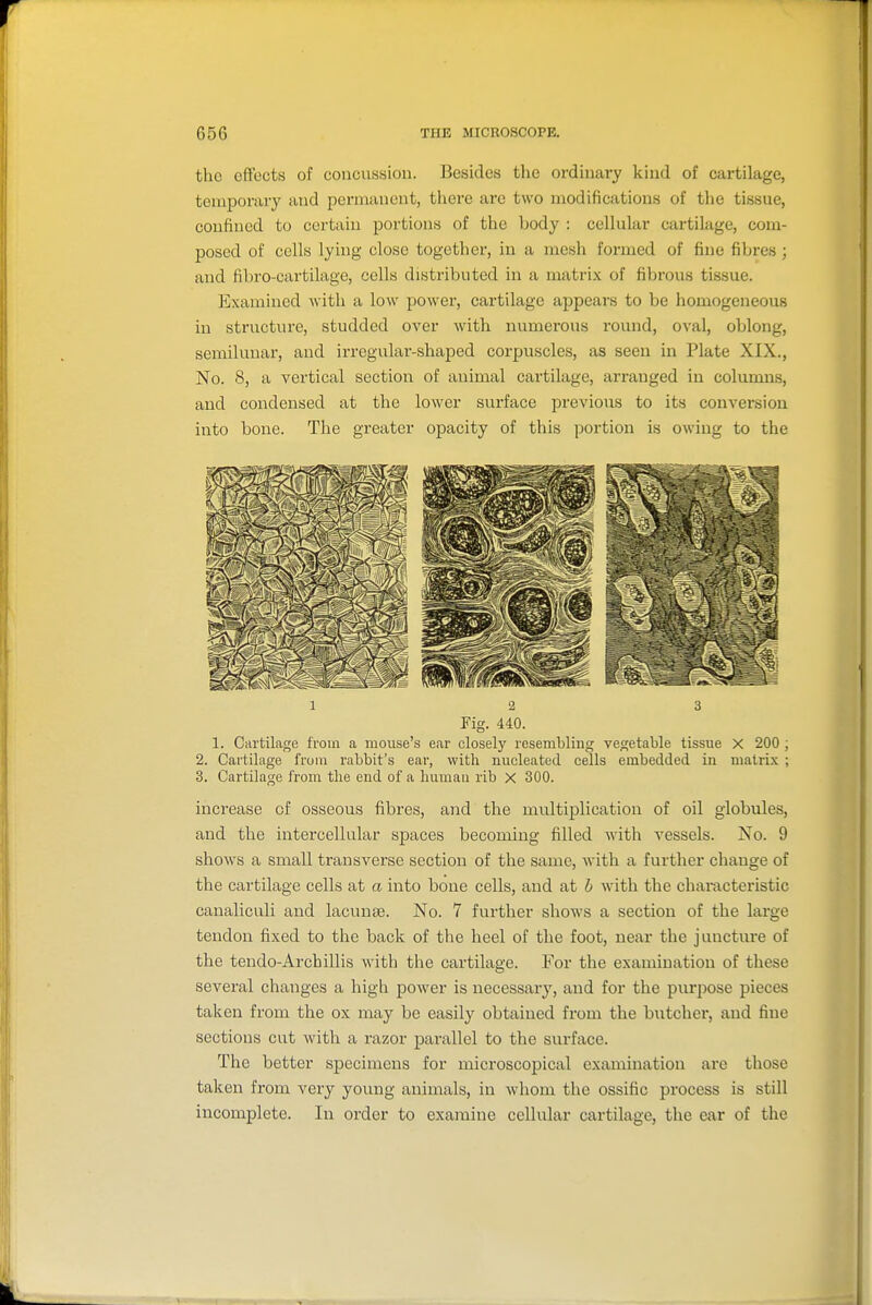 the effects of concussion. Besides tlie ordinary kind of cartilage, temporary and permanent, there are two modifications of the tissue, confined to certain portions of the body : cellular cartilage, com- posed of cells lying close together, in a mesh formed of fine fibres; and fil)ro-cartilage, cells distributed in a matri.x of fibrous tissue. Examined with a low power, cartilage appears to be homogeneous in structure, studded over with numerous round, oval, oblong, semilunar, and irregular-shaped corpuscles, as seen in Plate XIX., No. 8, a vertical section of animal cartilage, arranged in columns, and condensed at the lower surface previous to its conversion into bone. The greater opacity of this portion is owing to the 1 2 3 Fig. 440. 1. Cartilage from a mouse's ear closely resembling vegetable tissue X 200 ; 2. Cartilage from rabbit's eai', with nucleated cells embedded in matrix ; 3. Cartilage from the end of a humau rib X 300. increase of osseous fibres, and the multiplication of oil globules, and the intercellular spaces becoming filled with vessels. No. 9 shows a small transverse section of the same, with a further change of the cartilage cells at a into bone cells, and at b with the characteristic canaliculi and lacuute. No. 7 further shows a section of the large tendon fixed to the back of the heel of the foot, near the junctui'e of the tendo-Archillis with the cartilage. For the examination of these several changes a high power is necessary, and for the purpose pieces taken from the ox may be easily obtained from the butcher, and fine sections cut with a razor parallel to the surface. The better specimens for microscopical examination are those taken from very young animals, in whom the ossific process is still incomplete. In order to examine cellular cartilage, the ear of the