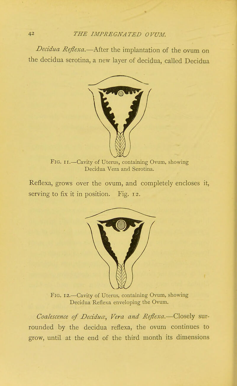 Decidua Reflexa.—After the implantation of the ovum on the decidua serotina, a new layer of decidua, called Decidua Fig. ii.—Cavity of Uterus, containing Ovum, showing Decidua Vera and Serotina. Reflexa, grows over the ovum, and completely encloses it, serving to fix it in position. Fig. 12. Fig. 12.—Cavity of Uterus, containing Ovum, showing Decidua Reflexa enveloping the Ovum. Coalescence of Decidual, Vera and Reflexa.—Closely sur- rounded by the decidua reflexa, the ovum continues to grow, until at the end of the third month its dimensions