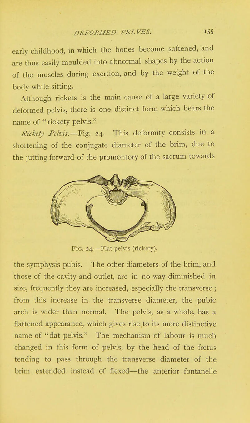 early childhood, in which the bones become softened, and are thus easily moulded into abnormal shapes by the action of the muscles during exertion, and by the weight of the body while sitting. Although rickets is the main cause of a large variety of deformed pelvis, there is one distinct form which bears the name of  rickety pelvis. Rickety Pelvis.— Fig. 24. This deformity consists in a shortening of the conjugate diameter of the brim, due to the jutting forward of the promontory of the sacrum towards Fig. 24.—Flat pelvis (rickety). the symphysis pubis. The other diameters of the brim, and those of the cavity and outlet, are in no way diminished in size, frequently they are increased, especially the transverse ; from this increase in the transverse diameter, the pubic arch is wider than normal. The pelvis, as a whole, has a flattened appearance, which gives rise to its more distinctive name of  flat pelvis. The mechanism of labour is much changed in this form of pelvis, by the head of the foetus tending to pass through the transverse diameter of the brim extended instead of flexed—the anterior fontanelle