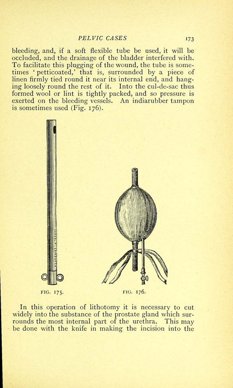 bleeding, and, if a soft flexible tube be used, it will be occluded, and the drainage of the bladder interfered with. To facilitate this plugging of the wound, the tube is some- times ' petticoated,' that is, surrounded by a piece of linen firmly tied round it near its internal end, and hang- ing loosely round the rest of it. Into the cul-de-sac thus formed wool or lint is tightly packed, and so pressure is exerted on the bleeding vessels. An indiarubber tampon is sometimes used (Fig. 176). FIG. 175. FIG. 176. In this operation of lithotomy it is necessary to cut widely into the substance of the prostate gland which sur- rounds the most internal part of the urethra. This may be done with the knife in making the incision into the
