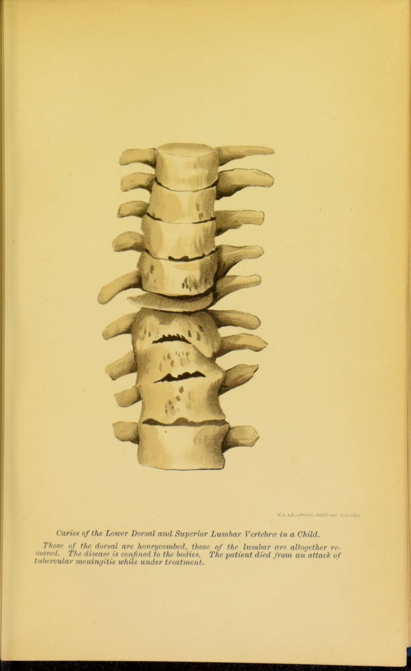 Those of the dorml are honeycombed, tho^e of the lumbar are aUo(jether re- vioved. The dUeaxe in confined to the bodies. The patient died from an attack of tubercular nwningitis while under treatment.
