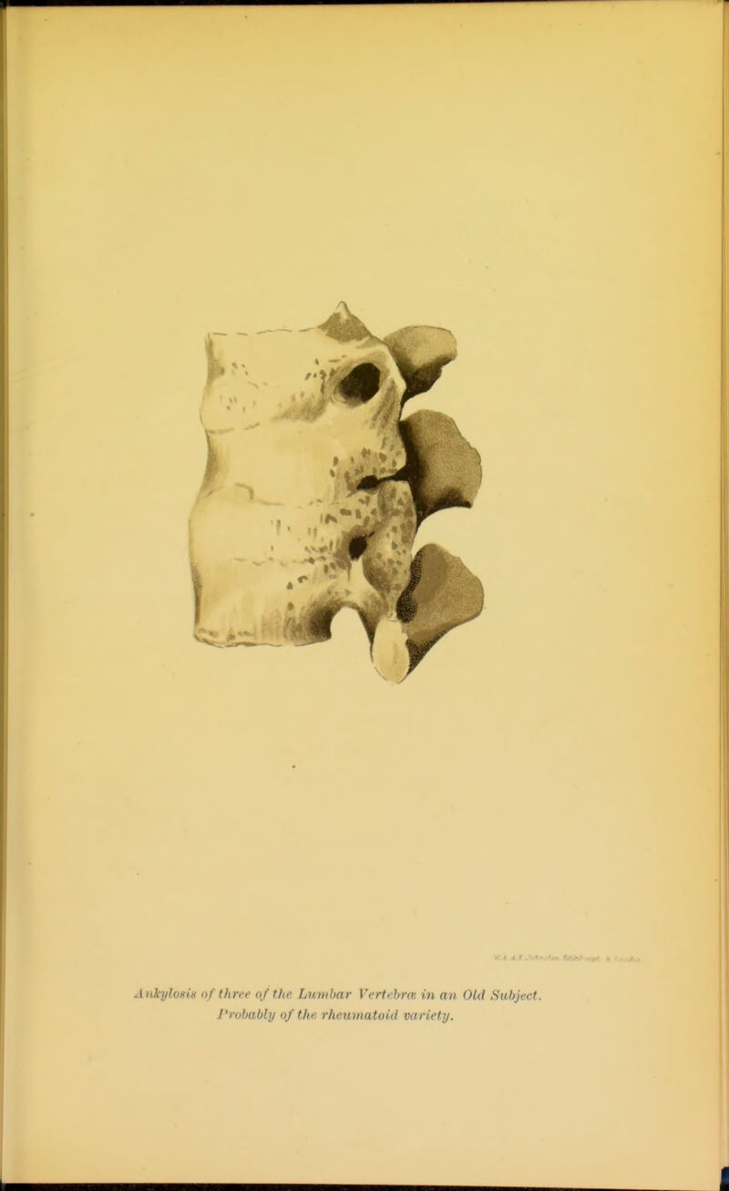 Ankyloxis of three of the Lumbar Vertebra; in an Old Sat>ject. I'rohably of the, rheuuiatoiil variety.