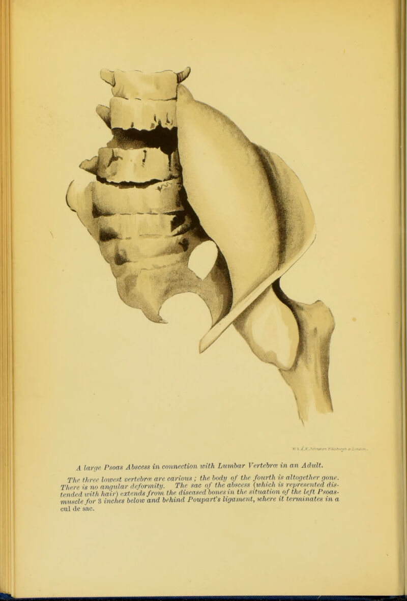A lar<ie. Psoas Abscess in connection vrith Lumbar Vertelyra in an Adult. Thn three lowest vertebra! are carious ; the body of the fourth is altogether gone. There is no angular deformity. The sac of the abscess (which is represnifed dis- tended with hair) ,-xt<;rids from the difeaned bones in the sitXMtion of the left Psoas- muscle for 3 iiiches below and behind Poupart's ligament, where it terminates in a ciil de sac.