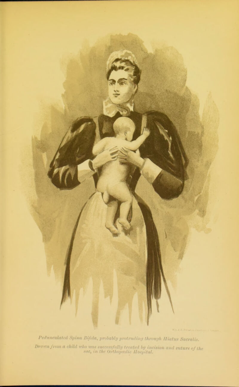 PethituiiUatcd Spina liljhia, jirobably protruOiiKj IhmiKjh Iliutuii Sacralix. Drij'snfrtim a child who 7cns sucrr.'Oi/iill!/ in-ateil bji incision and stiture of (he ' ■. ■ 'III' (Irtliopihdic Hoin>ital.