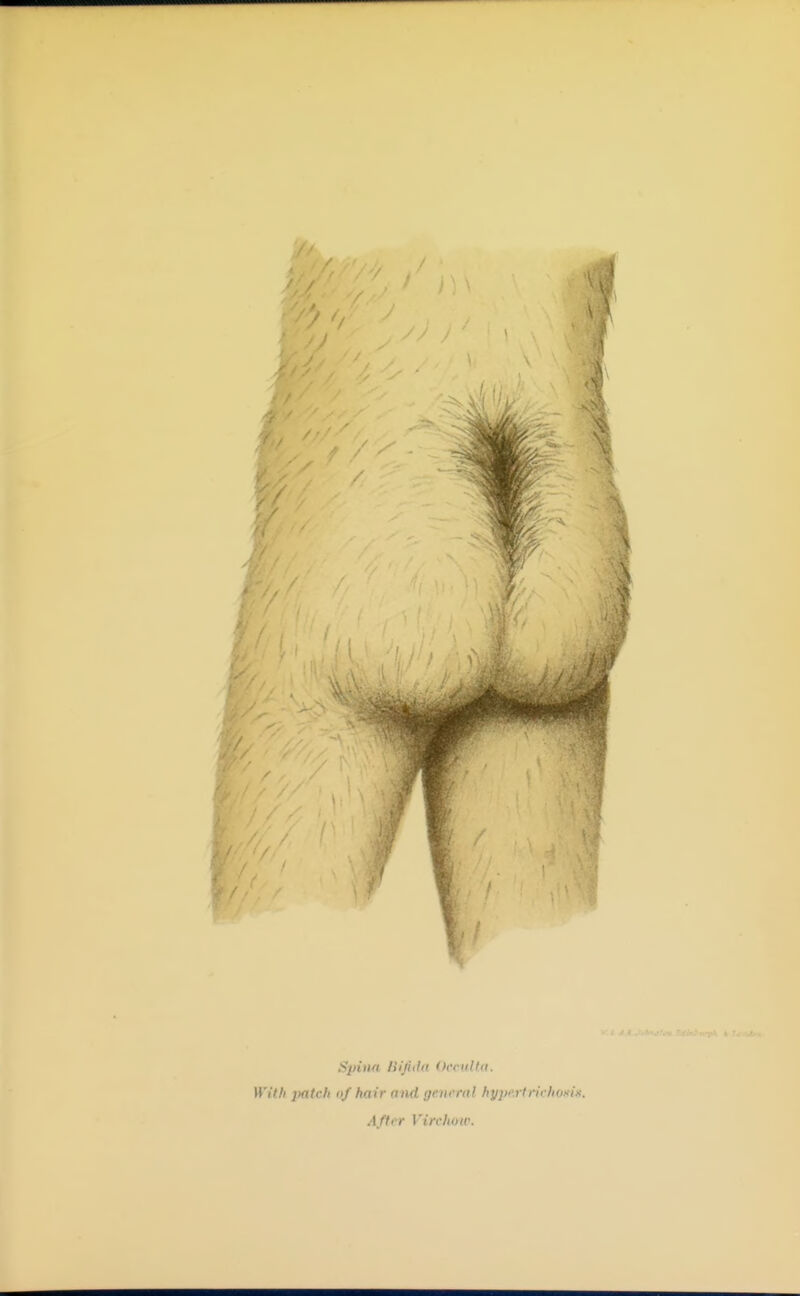 Spinn liijiiht Occulta. With jMtch of hair and general hypert rich oxIh. After Virchow.