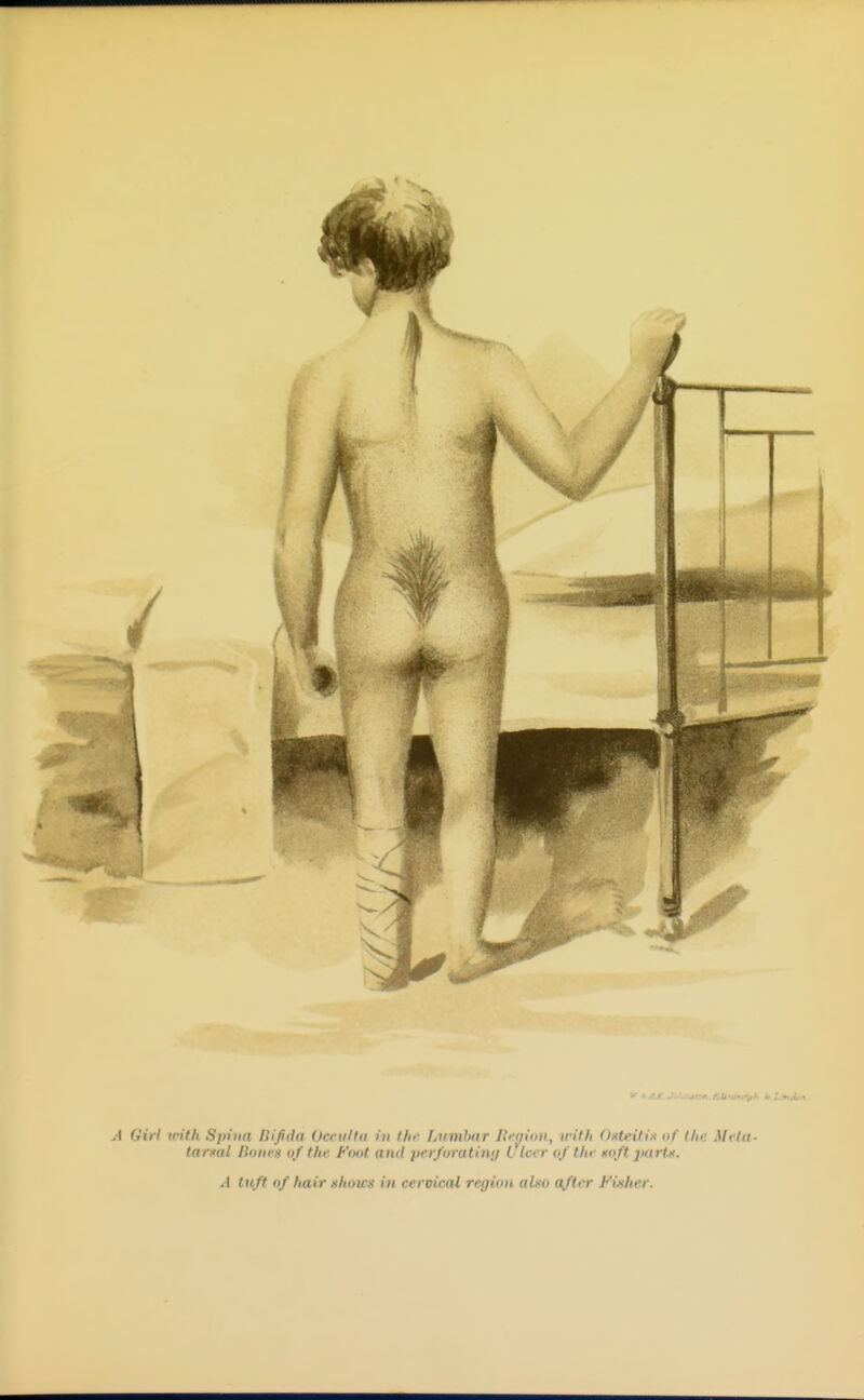 A Girl irith Spina llifida Occulta in tin' Lumbar lli'aiou, with Oxteiti.i nf tin; Mela- tarxal Honrs of the Foot and per/oratin;/ Ulcer of the Koft jtartx. A tuft of liair xhows in cervical region alxo after Fijiher.