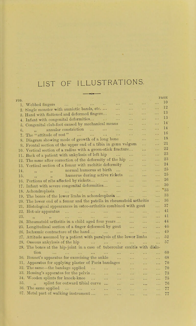 LIST OF ILLUSTRATIONS. PAGE MO. 1. Webbed fingers 2. Single monster with amniotic bands, etc 3. Hand with flattened and deformed fingers 13 4. Infant with congenital deformities 13 5. Congenital club-foot caused by mechanical means 14 6. „ annular constriction 1* 7. The  attitude of rest  1^ 8. Diagram showing mode of growth of a long bone 18 9. Frontal section of the upper end of a tibia in genu valgum 21 10. Vertical section of a radius with a green-stick fracture 22 11. Back of a patient with ankylosis of left hip 23 12. The same after correction of the deformity of the hip 23 13. Vertical section of a femur with rachitic deformity 24 14. „ „ normal humerus at birth 25 15. „ humeiais during active rickets 25 10. Portions of ribs affected by rickets 26 17. Infant with severe congenital deformities 30 18. Achondroplasia ... ... ... ■•• ■•• •• ••• ••• 33 19. The bones of the lower limbs in achondroplasia 33 20. The lower end of a femur and the patella in rheumatoid arthi'itis ... 36 21. Hi.stological appearances in osteo-arthritis combined with gout ... 37 22. Hot-air apparatus ... ... ... ... ... ... ... ... 41 23. „ „ 41 24. Eheumatoid arthritis in a child aged four years ... ... ... ... 44 25. Longitudinal section of a finger deformed by gout ... ... ... 46 26. Ischsemic contracture of the hand 49 27. Attitude assumed by a patient with paralysis of the lower limbs ... 52 28. Osseous ankylosis of the hip ... ... 57 29. The bones at the hip-joint in a case oE tubercular coxitis with dielo- tion ... ... ... ... ... ... ... ... ... 60 30. Bonnet's apparatus for exercising the ankle ... ... ... ... 68 31. Apparatus for applying plaster of Paris bandages ... ... ... 70 32. The same—the bandage applied ... ... ... ... ... ... 70 33. Hessing's apparatus for the pelvis ... ... ... ... 73 34. Wooden splints for knock-knee ... ... ... ... ... ... 75 35. ,, splint for outward tibial curve ... ... ... ... ... 76 36. The same applied ... ... ... ... ... ... ... ... 77 37. Metal part of walking instrument 77