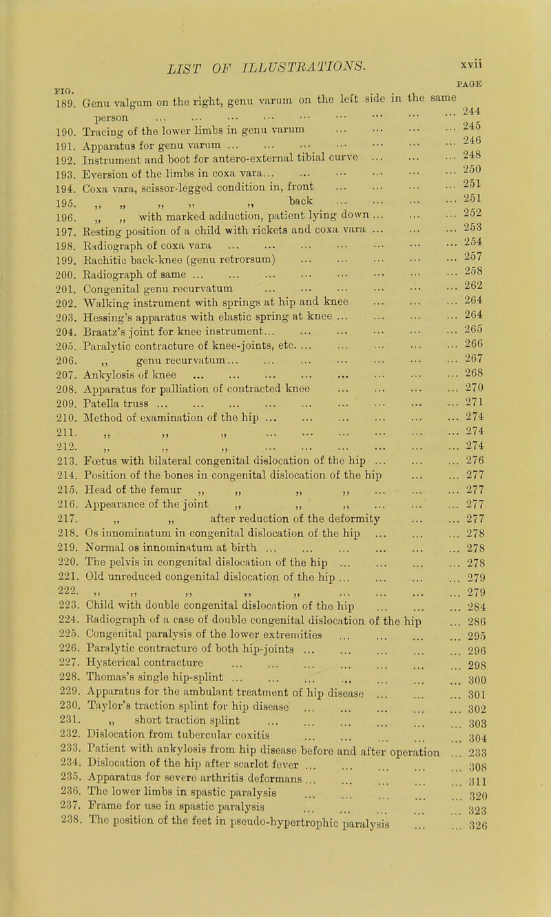 LIST OF ILLUSTRATIONS. xvii PAGE 189. Genu valgum on the right, genu varum on the left side in the same ... 244 person 190. Tracing of the lower limbs in genu varum 245 191. Apparatus for genu varum ^'^^ 192. Instrument and boot for antero-external tibial curve 248 193. Eversion of the limbs in coxa vara -'5^ 194. Coxa vara, scissor-legged condition in, front 251 10,5 . „ „ back ... ... ... ••• 251 196. „ „ with marked adduction, patient lying down -io/ 197. Resting position of a child with rickets and coxa vara 253 198. Rndiograph of coxa vara 254 199. Rachitic back-knee (genu retrorsum) 257 200. Radiograph of same 258 201. Congenital genu recurvatum 262 202. Walking instrument with springs at hip and knee 264 203. Hessing's apparatus with elastic spring at knee 264 204. Braatz's joint for knee instrument ... ••• ••• ••• 265 205. Paralytic contracture of knee-joints, etc 266 206. ,, genu recurvatum... ... ... ... ... ... .•• 267 207. Ankylosis of knee ... ... •■• 268 208. Apparatus for palliation of contracted knee 270 209. Patella truss 271 210. Method of examination of the hip ... ... ... 274 211. „ „ „ 274 212. „ „ „ ... 274 213. Foetus with bilateral congenital dislocation of the hip ... ... ... 276 214. Position of the bones in congenital dislocation of the hip ... ... 277 215. Head of the femur „ „ „ ,, ... ... ... 277 216. Appearance of the joint ,, ,, ,, ... ... ... 277 217. „ „ after reduction of the deformity ... ... 277 218. Os innominatum in congenital dislocation of the hip ... ... ... 278 219. Normal 08 innominatum at birth ... ... ... ... ... ... 278 220. The pelvis in congenital dislocation of the hip ... ... 278 221. Old unreduced congenital dislocation of the hip ... ... ... ... 279 222. „ „ „ „ „ 279 223. Child with double congenital dislocation of the hip 284 224. Radiograph of a case of double congenital dislocation of the hip ... 286 225. Congenital paralysis of the lower extremities 295 226. Paralytic contracture of both hip-joints ... ... ... ... ... 296 227. Hysterical contracture ... ... ... ... ... 298 228. Thomas's single hip-splint ,., _ _ 300 229. Apparatus for the ambulant treatment of hip disease 301 230. Taylor's traction splint for hip disease 302 231. „ short traction splint ... ... 303 232. Dislocation from tubercular co.xitis 304. 233. Patient with ankylosis from hip disease before and after operation ... 233 234. Dislocation of the hip after scarlet fever 308 235. Apparatus for .severe arthritis deformans 3II 230. The lower limbs in spastic paralysis 39O 237. Frame for use in spastic paralysis 323 238. The position of the feet in pseudo-hypertrophic paralysis 326