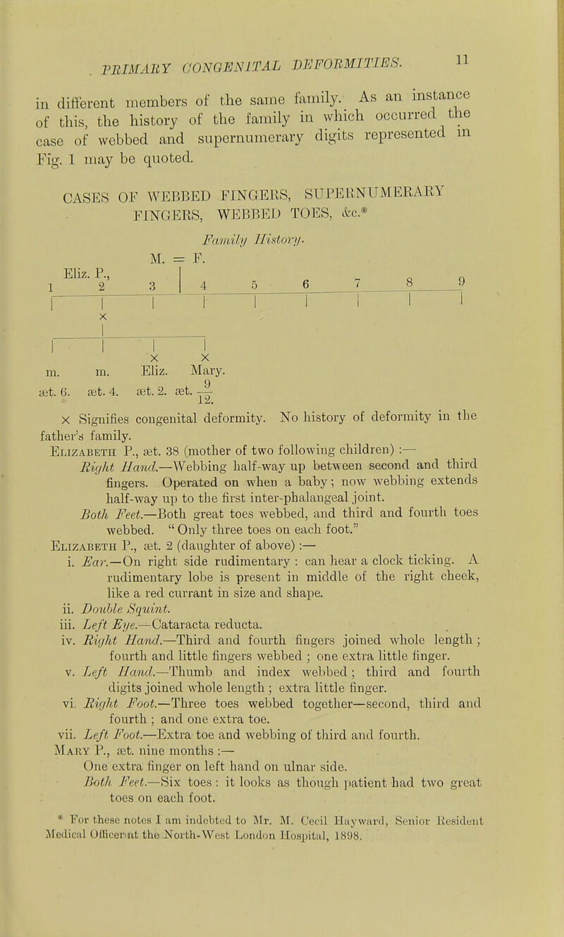 in different members of the same family. As an mstance of this, the history of the family in which occurred the case of webbed and supernumerary digits represented m Fig. 1 may be quoted. CASES OF WEBBED FINGERS, SUPEllNUMERAPtY FINGERS, WEBBED TOES, etc.* Family History' M. = F. zL r. f5 7 8 9 Eliz. P., X X m. m. Eliz. Mary. 9 ifit. 6. £et. 4. set. 2. tet. —- 12. X Signifies congenital deformity. No history of deformity in the fathei-'s family. Elizabeth P., tet. 38 (mother of two following children) :— Right //cMid—Webbing half-way up between second and third fingers. Operated on when a baby; now webbing extends half-way up to the first inter-phalangeal joint. Both i'^e^.—Both great toes webbed, and third and fourth toes webbed.  Only three toes on each foot. Elizabeth P., set. 2 (daughter of above):— i. Ear.—On right side rudimentary : can hear a clock ticking. A rudimentary lobe is present in middle of the right cheek, like a red currant in size and shape. ii. Double Squint. iii. Left Eye.—Cataracta reducta. iv. Eight Hand.—Third and fourth fingers joined whole length ; fourth and little fingers webbed ; one extra little finger. V. Left Hand.—Thumb and index webbed; third and fourth digits joined whole length ; extra little finger, vi. night Foot.—Three toes webbed together—second, third and fourth ; and one extra toe. vii. Left Foot.—Extra toe and webbing of third and fourth. Maiiy p., set. nine months :— One extra finger on left hand on ulnar side. JJoth Feet.—Six toes : it looks as though ]»atient had two great toes on each foot. * For these notes I am indebted to Mr. M. Cecil Hay ward, Senior Resident Medical OtBcerifit the North-West London Hospital, 1898.