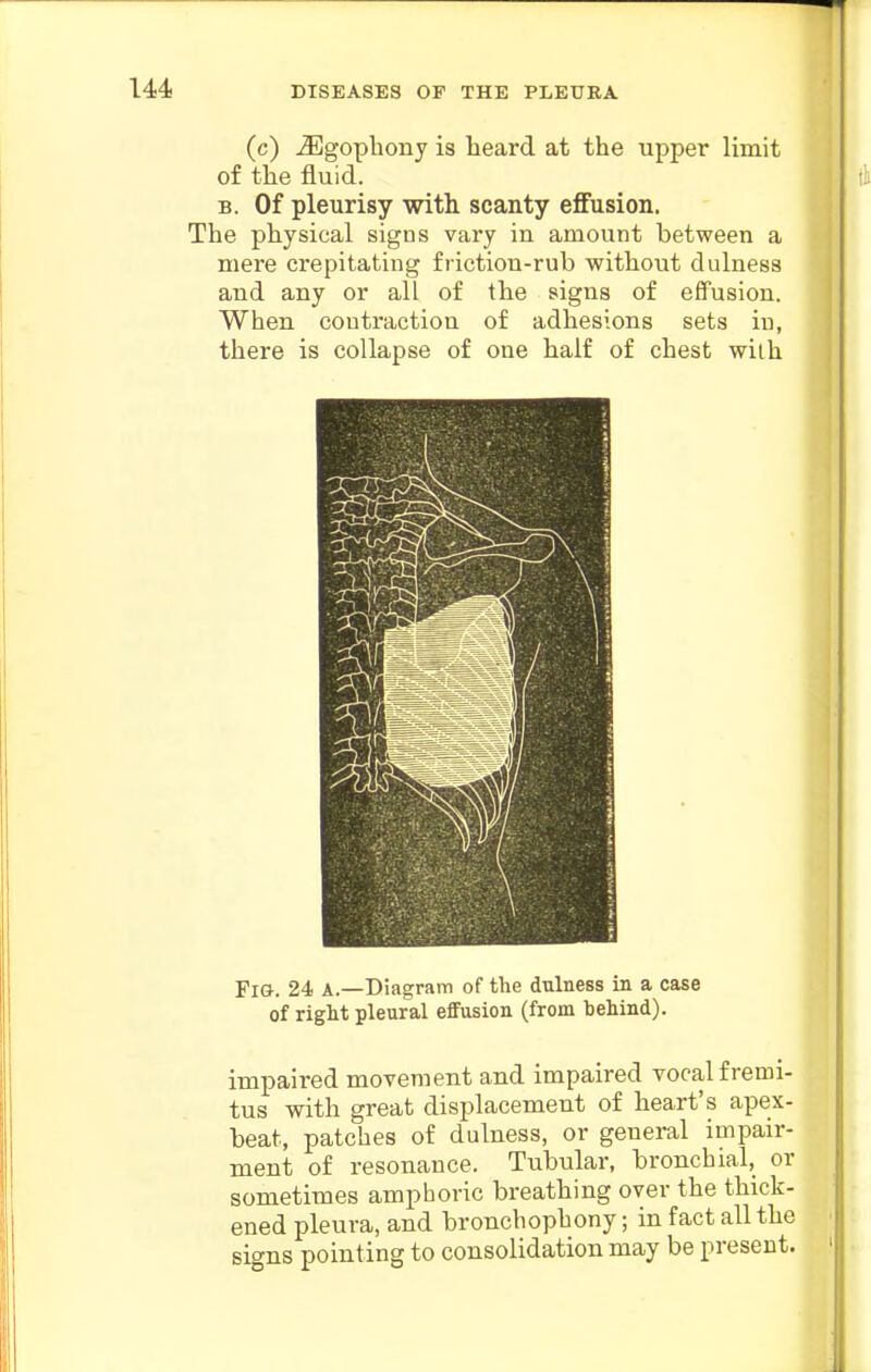 (c) iEgopbony is heard at the upper limit of the fluid. B. Of pleurisy with scanty efiFusion. The physical signs vary in amount between a mere crepitating friction-rub without dulness and any or all of the signs of effusion. When contraction of adhesions sets in, there is collapse of one half of chest with Fio. 24 A.—Diagram of the dulness in a case of right pleural effusion (from behind). impaired moveraent and impaired vocal fremi- tus with great displacement of heart's apex- beat, patches of dulness, or geuei-al impair- ment of resonance. Tubular, bronchial, or sometitnes amphoric breathing over the thick- ened pleura, and bronchophony; in fact all the signs pointing to consolidation may be present.