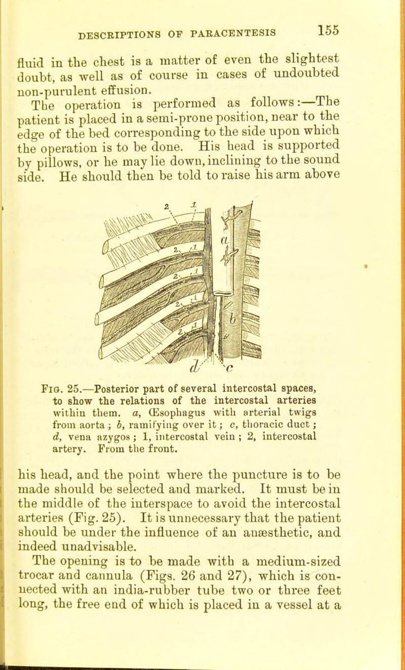 DESCEIPTIONS OF PARACENTESIS fluid in the chest is a matter of even the slightest doubt, as well as of course in cases of undoubted non-purulent effusion. The operation is performed as follows:—The patient is placed in a semi-prone position, near to the edge of the bed corresponding to the side upon which the operation is to be done. His head is supported by pillows, or he may lie down, inclining to the sound side. He should then be told to raise his arm above Fig. 25.—Posterior part of several intercostal spaces, to show the relations of the intercostal arteries within them, a, ffisophagus with arterial twigs from aorta ; b, ramifying over it; c, tlioracic duct; d, vena azygos; 1, intercostal vein ; 2, intercostal artery. From the front. his head, and the point where the puncture is to be made should be selected and marked. It must be in the middle of the interspace to avoid the intercostal arteries (Fig. 25). It is unnecessary that the patient should be under the influence of an anaesthetic, and indeed unadvisable. The opening is to be made with a medium-sized trocar and cannula (Figs. 26 and 27), which is con- nected with an india-rubber tube two or three feet long, the free end of which is placed in a vessel at a