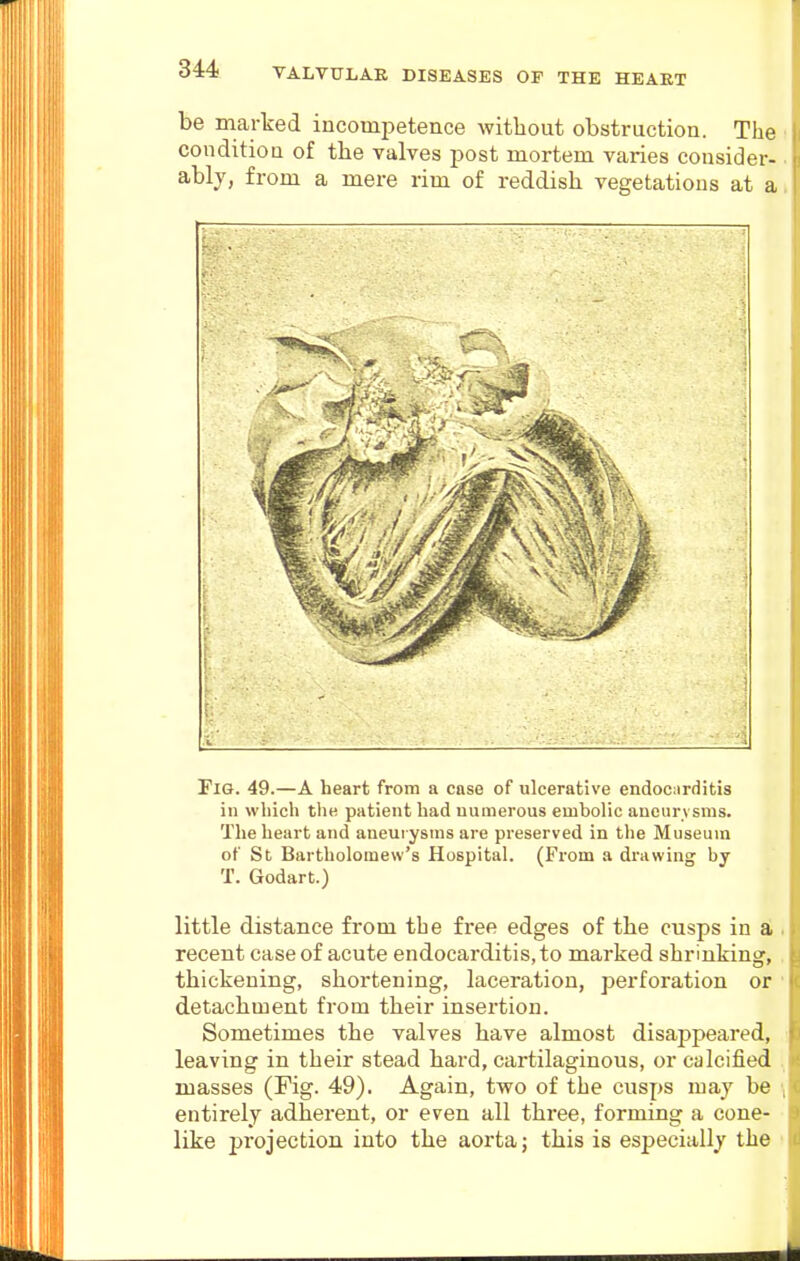 be marked incompetence without obstruction. The ■ conditiou of the valves post mortem varies consider- ■ ablj, from a mere rim of reddish vegetations at a< Fig. 49.—A heart from a case of ulcerative endocarditis in which the patient had numerous embolic ancurvsnis. The heart and aneurysms are preserved in tlie Museum of St Bartholomew's Hospital. (From a drawing by T. Godart.) little distance from the free edges of the cusps in a . recent case of acute endocarditis, to marked shrinking, . thickening, shortening, laceration, perforation or ■ detachment from their insertion. Sometimes the valves have almost disajjpeared, leaving in their stead hai'd, cartilaginous, or calcified . masses (Fig. 49). Again, two of the cusps may be entirely adherent, or even all three, forming a cone- • like projection into the aorta; this is especially the i