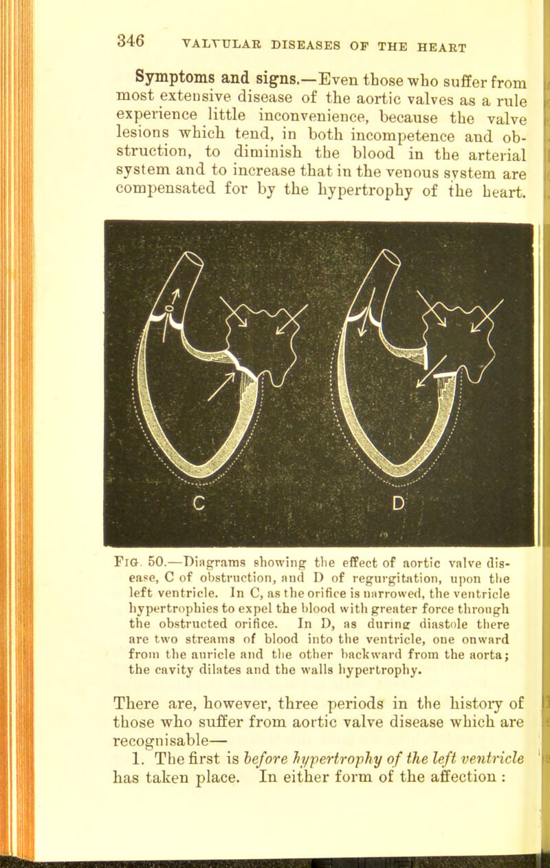 Symptoms and signs.—Even those who suffer from most extensive disease of the aortic valves as a rule experience little inconvenience, because the valve lesions which tend, in both incompetence and ob- struction, to diminish the blood in the arterial system and to increase that in the venous system are compensated for by the hypertrophy of the heart. C D. Fig. 50.—Diagrams showing the effect of aortic valve dis- ease, C of obstruction, and D of regurgitation, upon tlie left ventricle. In C, as the orifice is narrowed, the ventricle hypertrophies to expel the blood with greater force through the obstructed orifice. In D, as during diastole there are two streams of blood into the ventricle, one onward from the auricle and the otlier backward from the aorta j the cavity dilates and the walls hypertrophy. There are, however, three periods in the histoiy of those who suffer from aortic valve disease which are recognisable— 1. The first is before 7ii/pertrophy of the left ventricle has taken place. In either form of the affection :