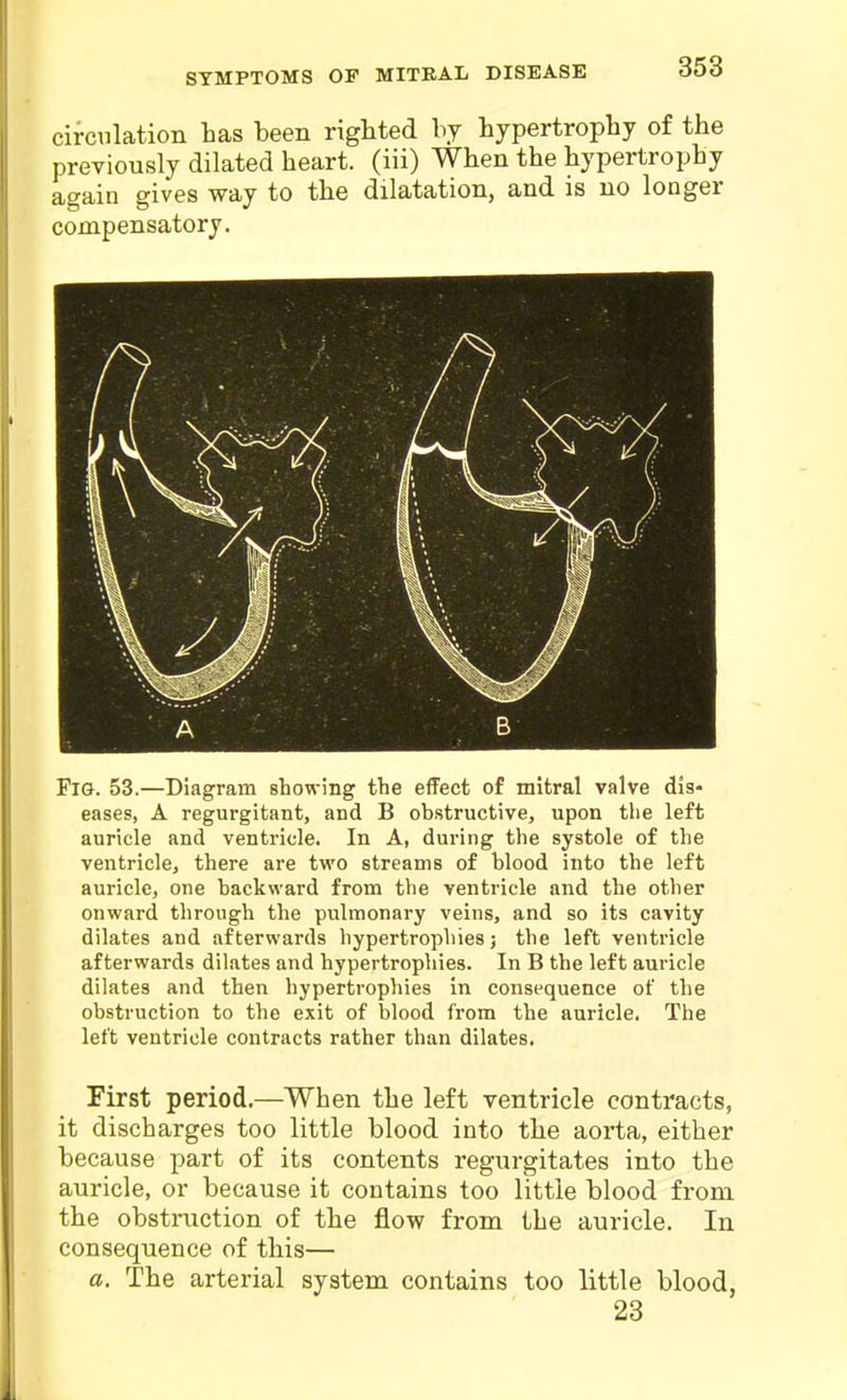 circulation has been righted by hypertrophy of the previously dilated heart, (iii) When the hypertrophy again gives way to the dilatation, and is no longer compensatory. Fig. 53.—Diagram showing the effect of mitral valve dis- eases, A regurgitant, and B obstructive, upon the left auricle and ventricle. In A, during the systole of the ventricle, there are two streams of blood into the left auricle, one backward from the ventricle and the other onward through the pulmonary veins, and so its cavity dilates and afterwards hypertrophies; the left ventricle afterwards dilates and hypertrophies. In B the left auricle dilates and then hypertrophies in consequence of the obstruction to the exit of blood from the auricle. The left ventricle contracts rather than dilates. First period.—When the left ventricle contracts, it discharges too little blood into the aorta, either because part of its contents regurgitates into the auricle, or because it contains too little blood from the obstruction of the flow from the auricle. In consequence of this— a. The arterial system contains too little blood, 23