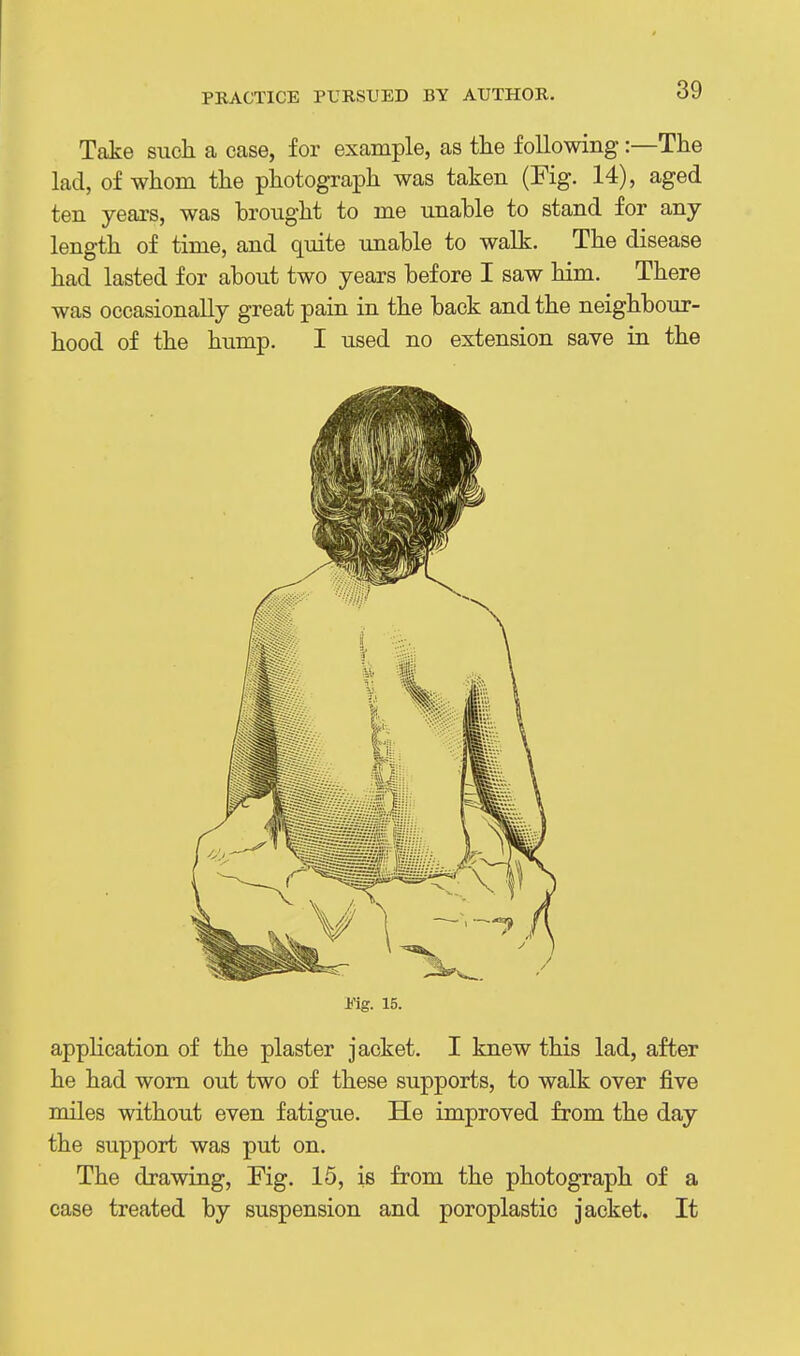 PRACTICE PURSUED BY AUTHOR. Take siicli a case, for example, as tlie following:—The lad, of whom the photograiah was taken (Fig. 14), aged ten yeai-s, was brought to me unable to stand for any length of time, and quite unable to walk. The disease had lasted for about two years before I saw him. There was occasionally great pain in the back and the neighbour- hood of the hump. I used no extension save in the Fig. 15. application of the plaster jacket. I knew this lad, after he had worn out two of these supports, to walk over five miles without even fatigue. He improved from the day the support was put on. The drawing. Fig. 15, is from the photograph of a case treated by suspension and poroplastic jacket. It