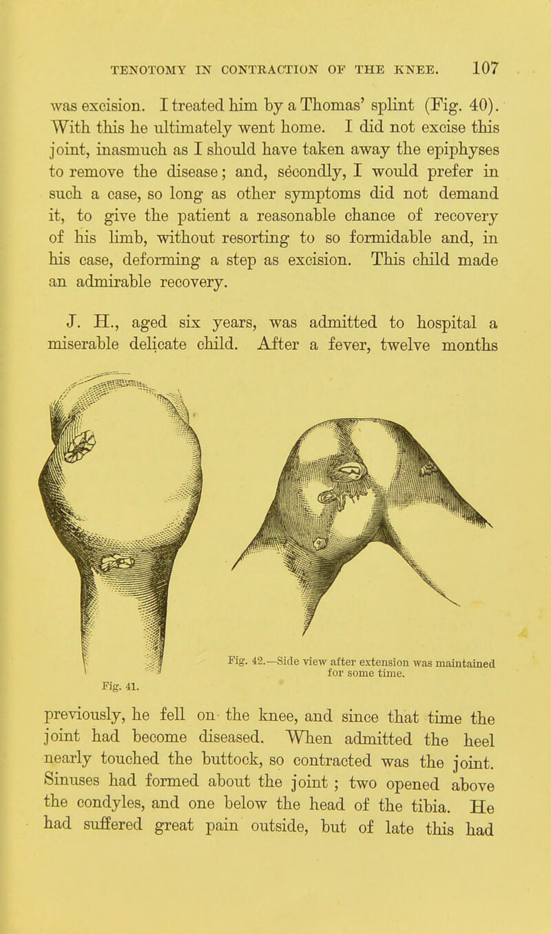 was excision. I treated him by a Thomas' splint (Fig. 40). With this he ultimately went home. I did not excise this joint, inasmuch as I should have taken away the epiphyses to remove the disease; and, secondly, I would prefer in such a case, so long as other symptoms did not demand it, to give the patient a reasonable chance of recovery of his limb, without resorting to so formidable and, in his case, deforming a step as excision. This child made an admirable recovery. J. H., aged six years, was admitted to hospital a miserable delicate child. After a fever, twelve months Fig. 41. previously, he fell on the knee, and since that time the joint had become diseased. When admitted the heel nearly touched the buttock, so contracted was the joint. Sinuses had formed about the joint ; two opened above the condyles, and one below the head of the tibia. He had suffered great pain outside, but of late this had