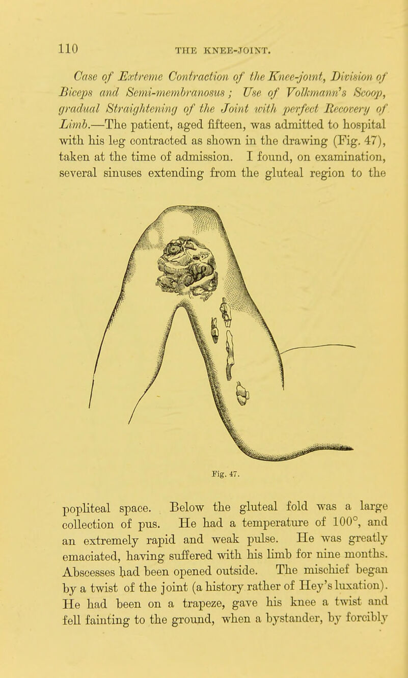 Case of Extreme Contraction of the Knee-joint, Division of Bicejis and Semi-menibranosus; Use of Volkmannh Scoop, gradual Straightening of the Joint with perfect Recovery of Limb.—The patient, aged fifteen, was admitted to hospital with his leg contracted as shown in the drawing (Fig. 47), taken at the time of admission, I found, on examination, several sinuses extending from the gluteal region to the Fig. 47. popliteal space. Below the gluteal fold was a large collection of pus. He had a temperatui'e of 100°, and an extremely rapid and weak pulse. He was greatly emaciated, having suffered with his limb for nine months. Abscesses had been opened outside. The mischief began by a twist of the joint (a history rather of Hey's luxation). He had been on a trapeze, gave his knee a twist and fell fainting to the ground, when a bystander, by forcibly