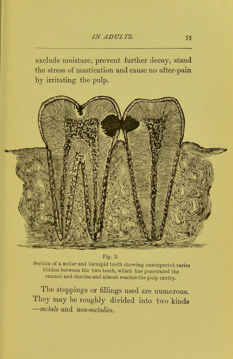 exclude moisture, prevent further decay, stand the stress of mastication and cause no after-pain by irritating the pulp. Fig. 2. Section of a molar and bicuspid tooth showing unsuspected caries hidden between the two teeth, which has penetrated the enamel and dentine and almost reaches the pulp cavity. The stoppings or fillings used are numerous. They may be roughly divided into two kinds —metals and non-metalies.