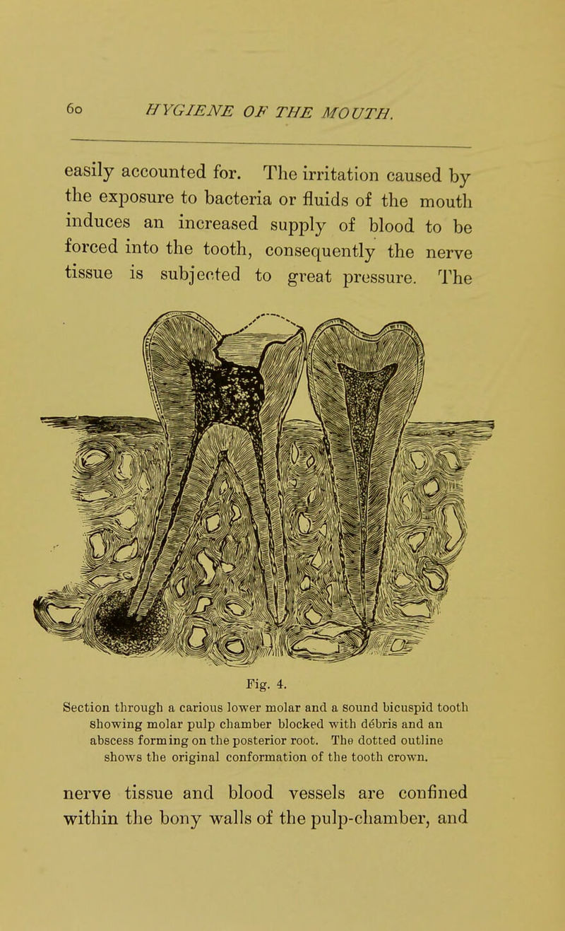 easily accounted for. The irritation caused by the exposure to bacteria or fluids of the mouth induces an increased supply of blood to be forced into the tooth, consequently the nerve tissue is subjected to great pressure. The Fig. 4. Section through a carious lower molar and a sound bicuspid tooth showing molar pulp chamber blocked with debris and an abscess forming on the posterior root. The dotted outline shows the original conformation of the tooth crown. nerve tissue and blood vessels are confined within the bony walls of the pulp-chamber, and