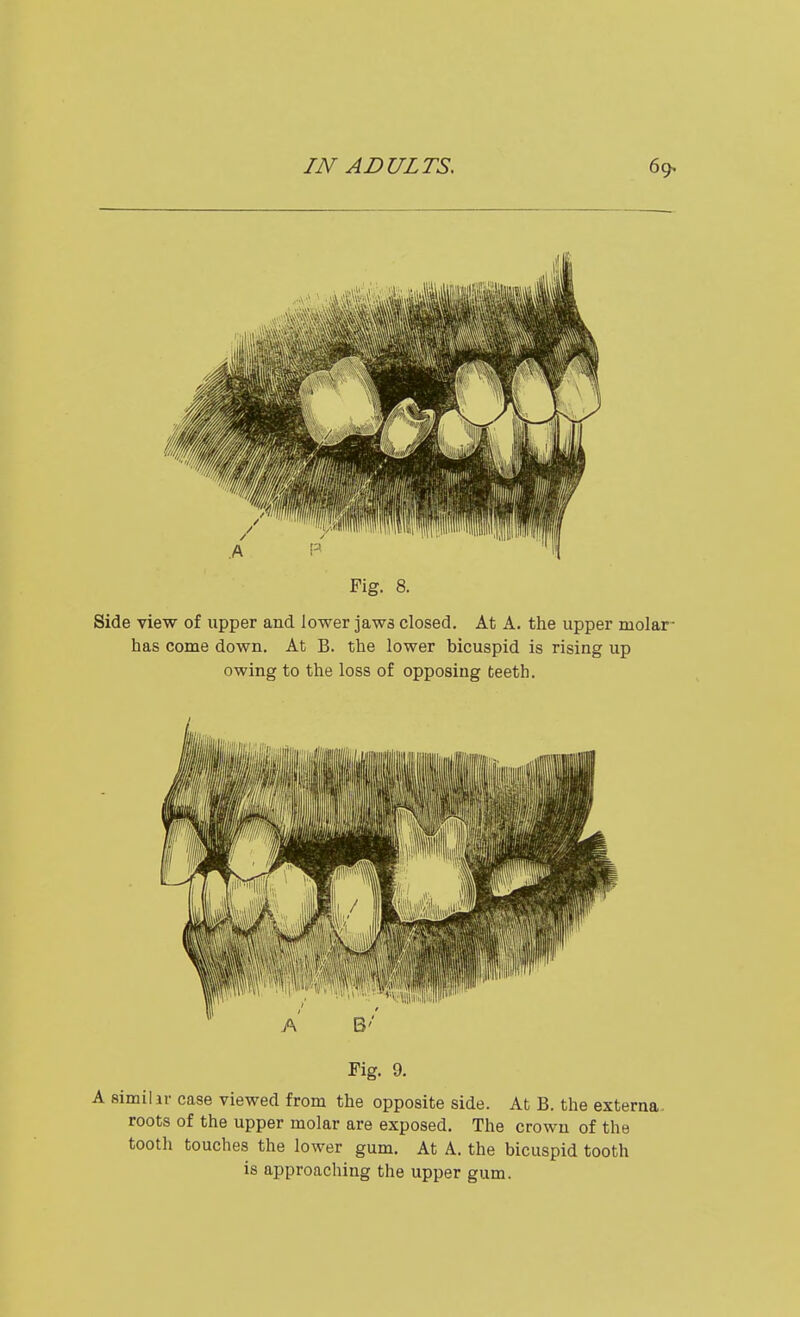 Fig. 8. Side view of upper and lower jaws closed. At A. the upper molar- has come down. At B. the lower bicuspid is rising up owing to the loss of opposing teeth. Fig. 9, A similir case viewed from the opposite side. At B. the externa roots of the upper molar are exposed. The crown of the tooth touches the lower gum. At A. the bicuspid tooth is approaching the upper gum.