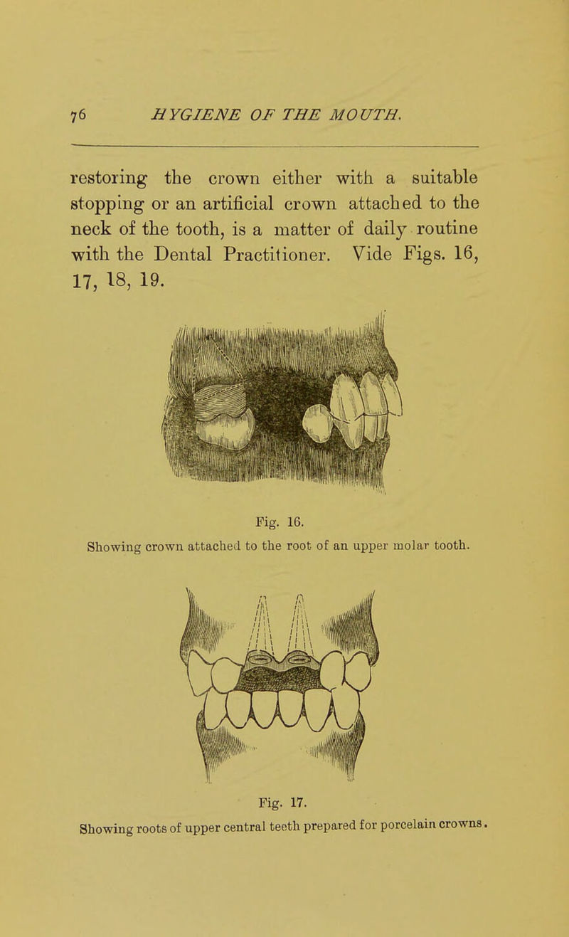 restoring the crown either with a suitable stopping or an artificial crown attached to the neck of the tooth, is a matter of daily routine with the Dental Practitioner. Vide Figs. 16, 17, 18, 19. Fig. 16. Showing crown attached to the root of an upper molar tooth. Fig. 17. Showing roots of upper central teeth prepared for porcelain crowns.