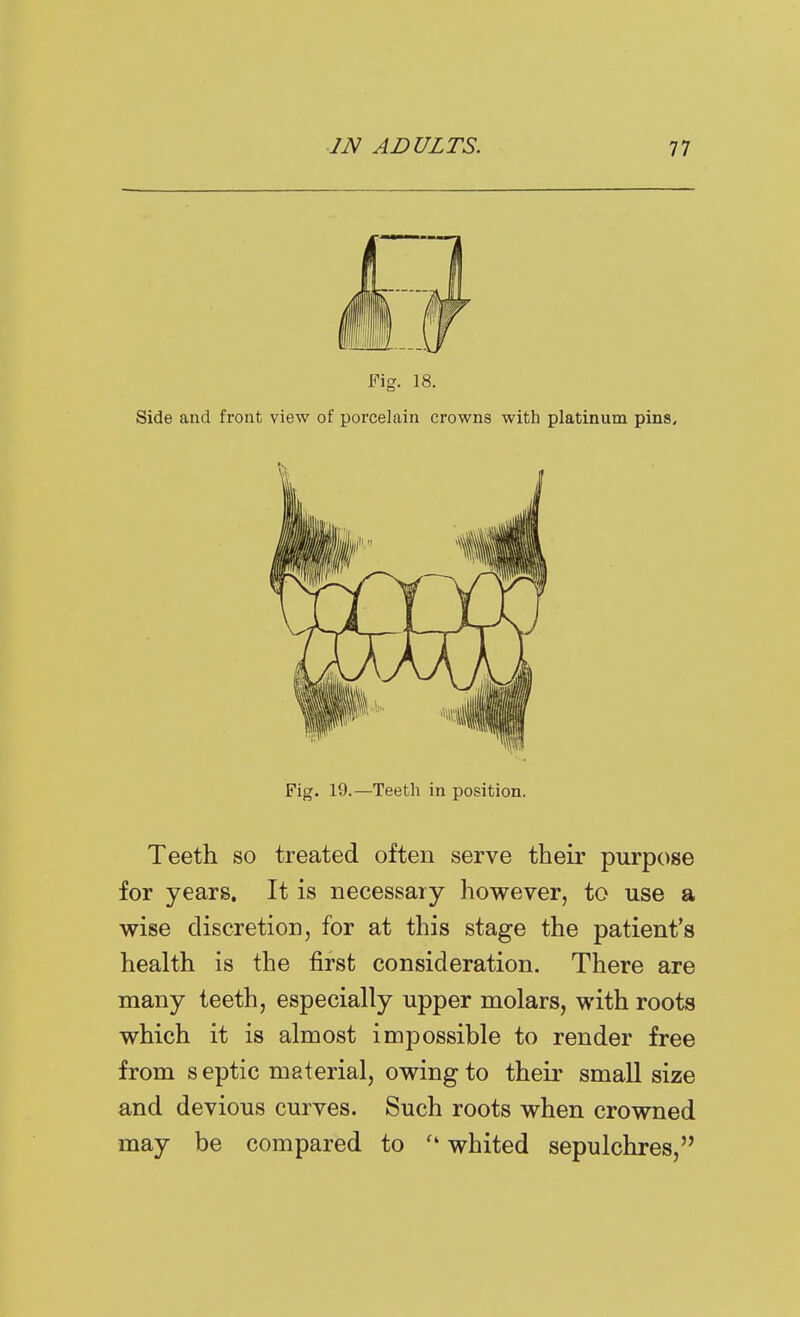 Fig. 18. Side and front view of porcelain crowns with platinum pins. Fig. 19.—Teeth in position. Teeth so treated often serve their purpose for years. It is necessary however, to use a wise discretion, for at this stage the patient's health is the first consideration. There are many teeth, especially upper molars, with roots which it is almost impossible to render free from septic material, owing to their small size and devious curves. Such roots when crowned may be compared to whited sepulchres,''