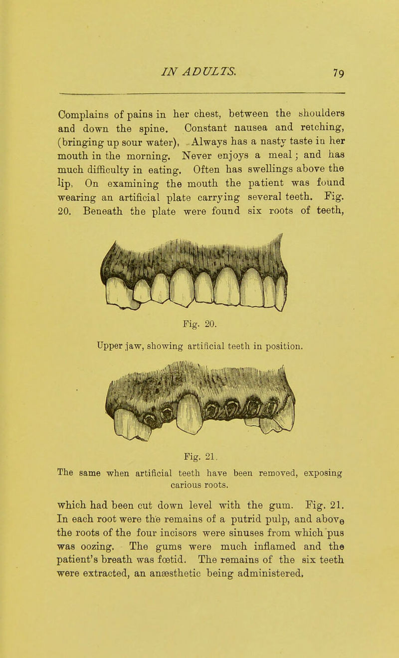 Complains of pains in her chest, between the tshoulders and down the spine. Constant nausea and retching, (bringing up sour water), Always has a nasty taste in her mouth in the morning. Never enjoys a meal; and has much difficulty in eating. Often has swellings above the lip, On examining the mouth the patient was found wearing an artificial plate carrying several teeth. Fig. 20. Beneath the plate were found six roots of teeth, Fig. 20. Upper jaw, showing artificial teeth in position. Fig, 21. The same when artificial teeth have been removed, exposing carious roots, which had been cut down level with the gum. Fig. 21. In each root were the remains of a putrid pulp, and above the roots of the four incisors were sinuses from which pus was oozing. The gums were much inflamed and the patient's breath was foetid. The remains of the six teeth were extracted, an ansesthetic being administered.