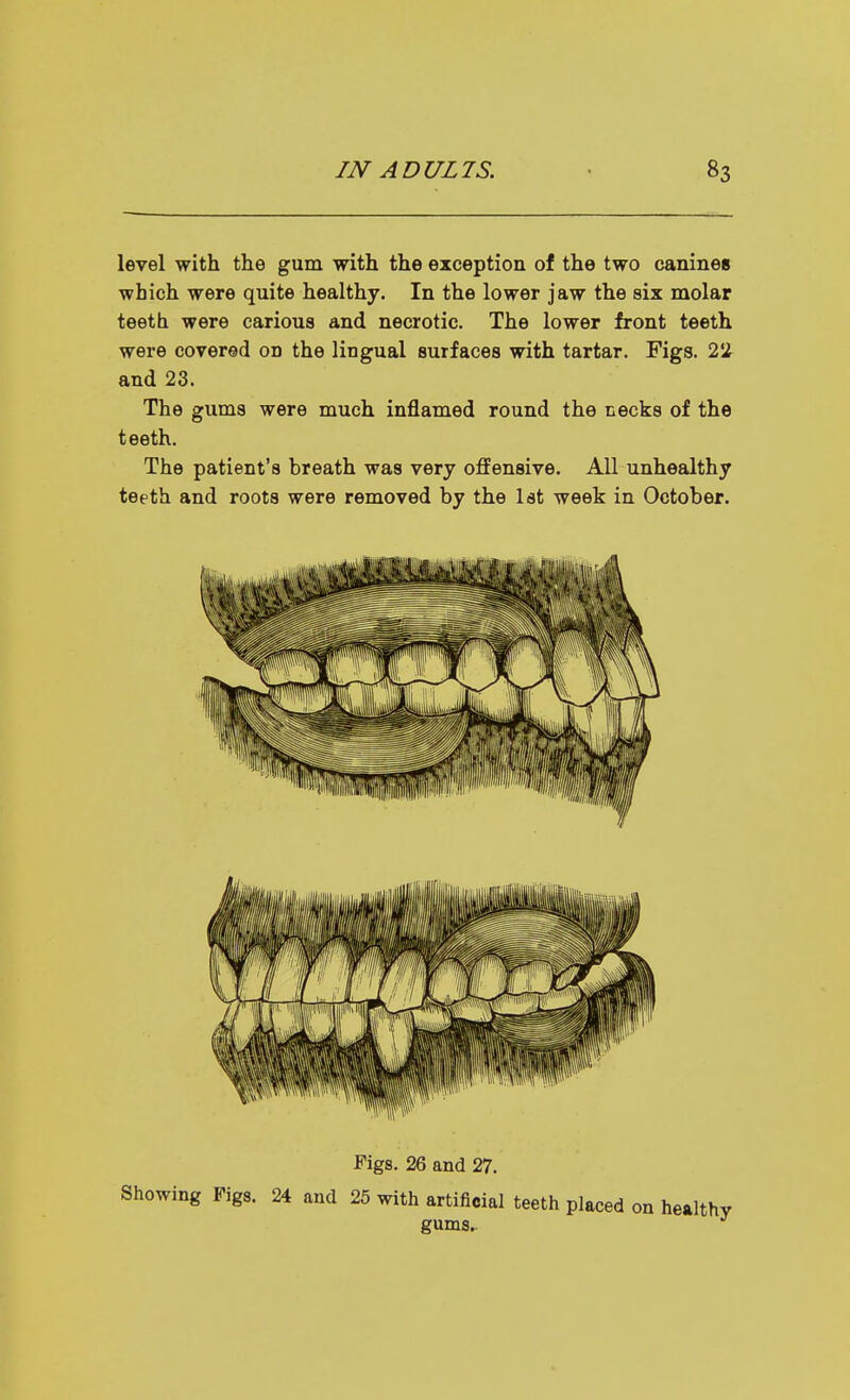 level with the gum with the exception of the two canines which were quite healthy. In the lower jaw the six molar teeth were carious and necrotic. The lower front teeth were covered on the lingual surfaces with tartar. Figs. 22^ and 23. The gums were much inflamed round the necks of the teeth. The patient's breath was very offensive. All unhealthy teeth and roots were removed by the 1st week in October. Pigs. 26 and 27. Showing Figs. 24 and 25 with artificial teeth placed on healthy gums.