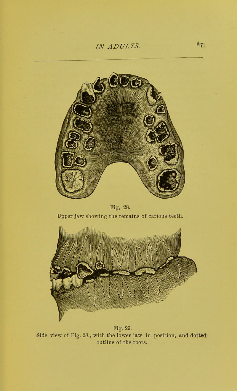 Fig, 28. Upper jaw showing the remains of carious teeth. Fig. 29. Side view of Fig. 28., with the lower jaw in position, and dotted outline of the roots.