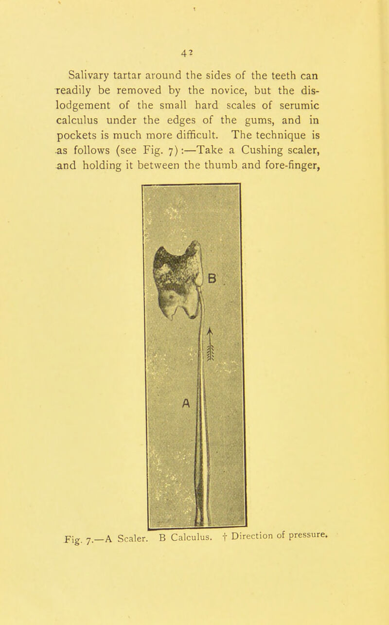 t 41 Salivary tartar around the sides of the teeth can readily be removed by the novice, but the dis- lodgement of the small hard scales of serumic calculus under the edges of the gums, and in pockets is much more difficult. The technique is .as follows (see Fig. 7):—Take a Gushing scaler, and holding it between the thumb and fore-finger,