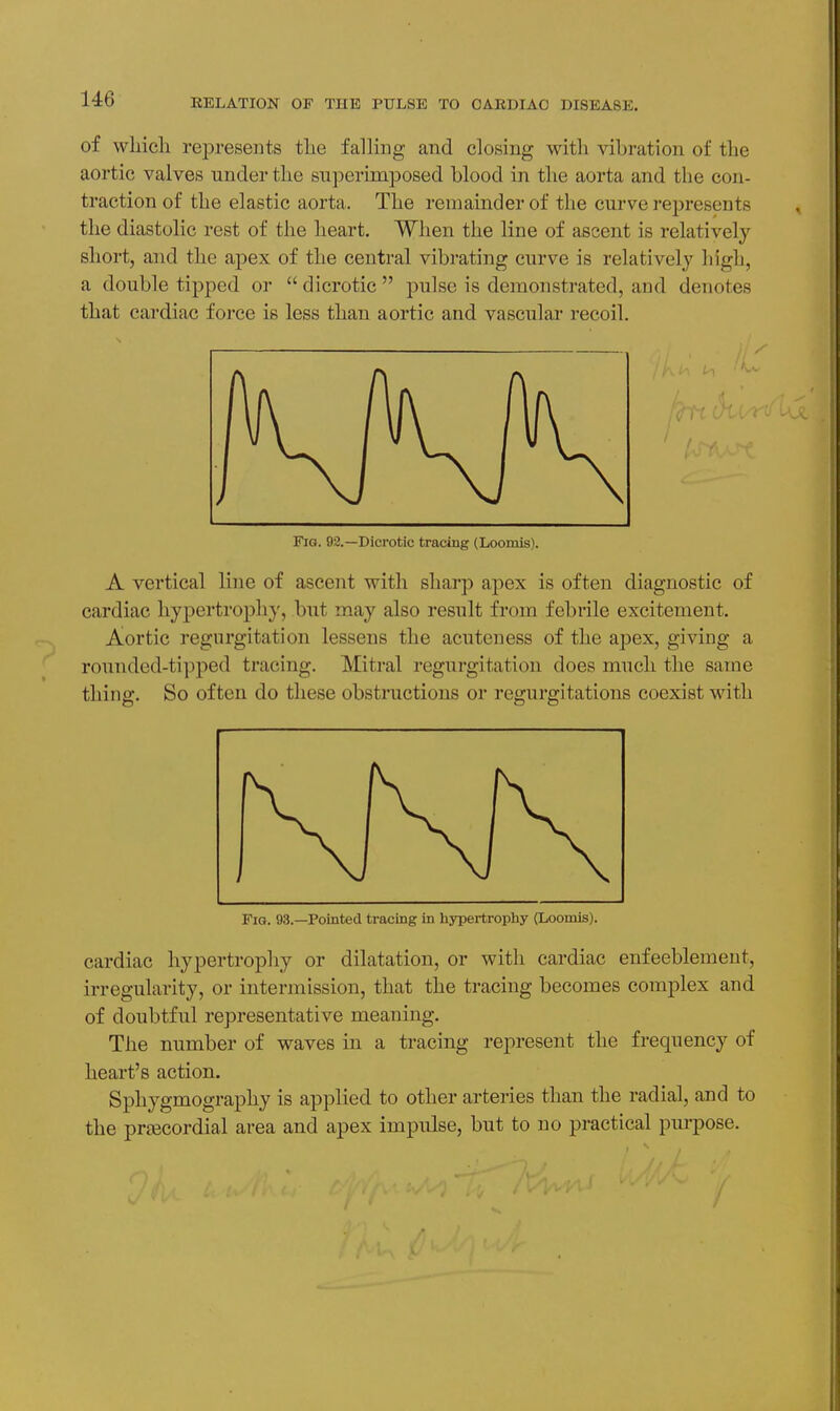 of wliich represents tlie falling and closing with vibration of the aortic valves under the superimposed blood in the aorta and the con- traction of the elastic aorta. The remainder of the curve represents the diastolic rest of the heart. When the line of ascent is relatively short, and the apex of the central vibrating curve is relatively high, a double tip2:)ed or  dicrotic  pulse is demonstrated, and denotes that cardiac force is less than aortic and vascular recoil. Fig. 92.—Dicrotic tracing (Loomis). A vertical line of ascent with sharp apex is often diagnostic of cardiac hypertrophy, but may also result from febrile excitement. Aortic regurgitation lessens the acuteness of the apex, giving a rounded-tipped tracing. Mitral regurgitation does much the same thing. So often do these obstructions or regurgitations coexist with Fig. 93.—Pointed tracing in hypertrophy (Loomis). cardiac hypertrophy or dilatation, or with cardiac enfeeblement, irregularity, or intermission, that the tracing becomes comjjlex and of doubtful representative meaning. The number of waves in a tracing represent the frequency of heart's action. Sphygmography is applied to other arteries than the radial, and to the priBCordial area and apex impulse, but to no practical purpose.