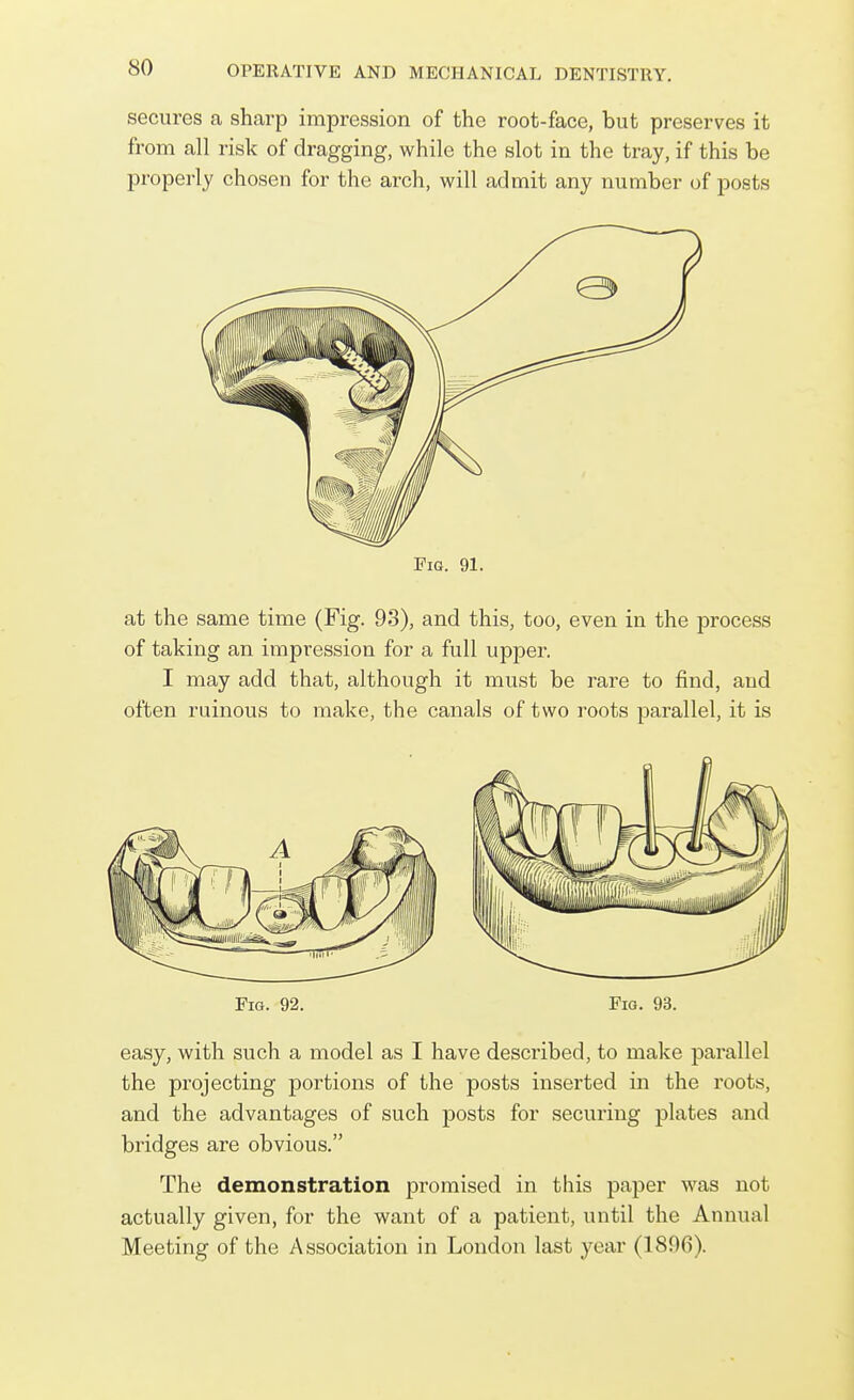 secures a sharp impression of the root-face, but preserves it from all risk of dragging, while the slot in the tray, if this be properly chosen for the arch, will admit any number of posts Pig. 91. at the same time (Fig. 93), and this, too, even in the ]Drocess of taking an impression for a full upjaer. I may add that, although it must be rare to find, and often ruinous to make, the canals of two roots parallel, it is Fig. 92. Fig. 93. easy, with such a model as I have described, to make parallel the projecting portions of the posts inserted in the roots, and the advantages of such posts for securing plates and bridges are obvious. The demonstration promised in this paper was not actually given, for the want of a patient, until the Annual Meeting of the Association in London last year (1896).