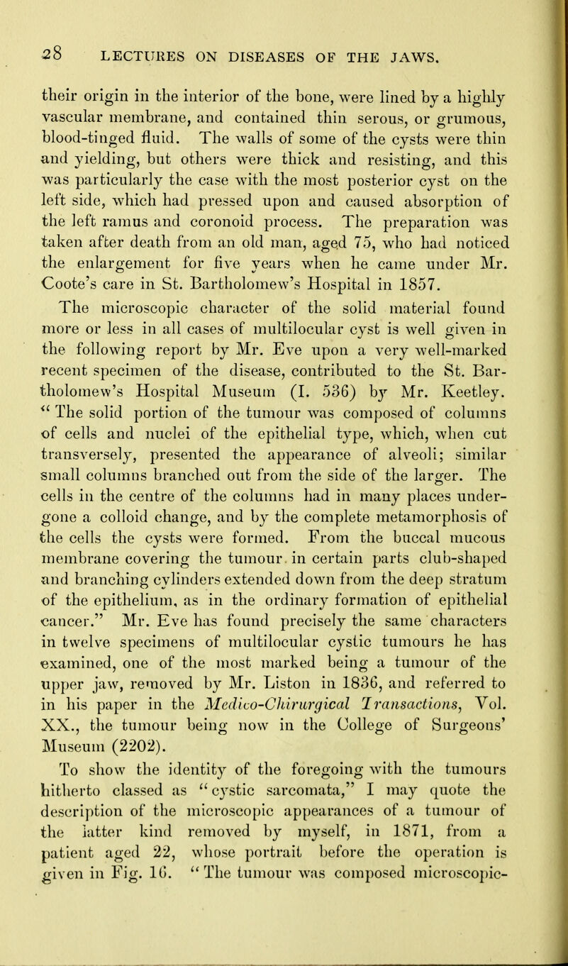 their origin in the interior of the bone, were lined by a highly vascular membrane, and contained thin serous, or grumous, blood-tinged fluid. The walls of some of the cysts were thin and yielding, but others were thick and resisting, and this was particularly the case with the most posterior cyst on the left side, which had pressed upon and caused absorption of the left ramus and coronoid process. The preparation was taken after death from an old man, aged 75, who had noticed the enlargement for five years when he came under Mr. Coote's care in St. Bartholomew's Hospital in 1857. The microscopic character of the solid material found more or less in all cases of multilocular cyst is well given in the following report by Mr. Eve upon a very well-marked recent specimen of the disease, contributed to the St. Bar- tholomew's Hospital Museum (I. 536) bj^ Mr. Keetley. The solid portion of the tumour was composed of columns of cells and nuclei of the epithelial type, which, when cut transversely, presented the appearance of alveoli; similar small columns branched out from the side of the larger. The cells in the centre of the columns had in many places under- gone a colloid change, and by the complete metamorphosis of the cells the cysts were formed. From the buccal mucous membrane covering the tumour, in certain parts club-shaped and branching cylinders extended down from the deep stratum of the epithelium, as in the ordinary formation of epithelial cancer. Mr. Eve has found precisely the same characters in twelve specimens of multilocular cystic tumours he has ^examined, one of the most marked being a tumour of the upper jaw, removed by Mr. Liston in 1836, and referred to in his paper in the Medico-Cliiriirgical Jransactions, Vol. XX., the tumour being now in the College of Surgeons' Museum (2202). To show the identity of the foregoing with the tumours hitherto classed as ^' cj^stic sarcomata, I may quote the description of the microscopic appearances of a tumour of the latter kind removed by myself, in 1871, from a patient aged 22, whose portrait before the operation is