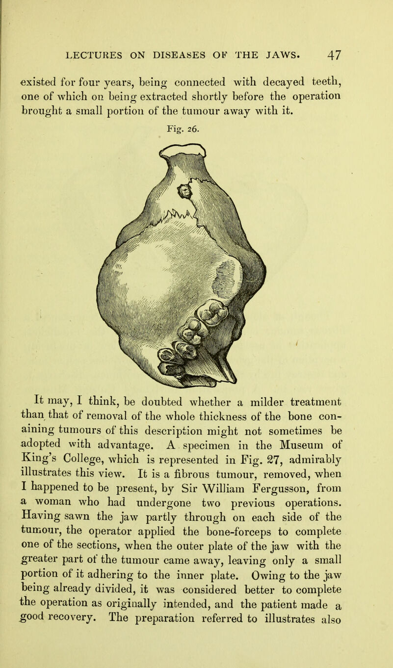existed for four years, being connected with decayed teeth, one of which on being extracted shortly before the operation brought a small portion of the tumour away with it. Fig. 26. It may, I think, be doubted whether a milder treatment than that of removal of the whole thickness of the bone con- aining tumours of this description might not sometimes be adopted with advantage. A specimen in the Museum of King's College, which is represented in Fig. 27, admirably illustrates this view. It is a fibrous tumour, removed, when I happened to be present, by Sir William Fergusson, from a woman who had undergone two previous operations. Having sawn the jaw partly through on each side of the tumour, the operator applied the bone-forceps to complete one of the sections, when the outer plate of the jaw with the greater part of the tumour came away, leaving only a small portion of it adhering to the inner plate. Owing to the jaw being already divided, it was considered better to complete the operation as originally intended, and the patient made a ^ood recovery. The preparation referred to illustrates also