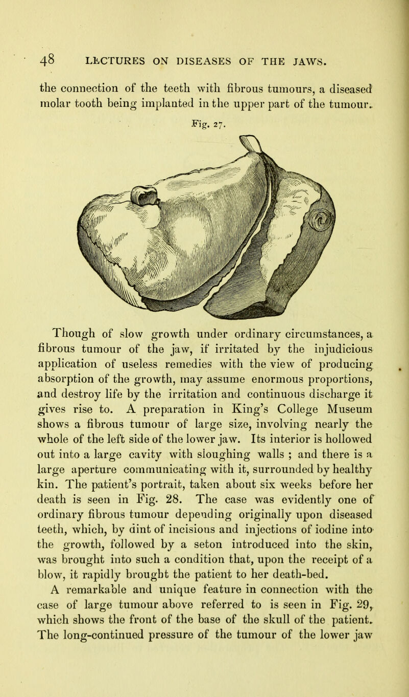 the connection of the teeth with fibrous tumours, a diseased molar tooth being implanted in the upper part of the tumour. Fig. 27. Though of slow growth under ordinary circumstances, a fibrous tumour of the jaw, if irritated by the injudicious application of useless remedies with the view of producing absorption of the growth, may assume enormous proportions, ^nd destroy life by the irritation and continuous discharge it gives rise to. A preparation in King's College Museum shows a fibrous tumour of large size, involving nearly the whole of the left side of the lower jaw. Its interior is hollowed out into a large cavity with sloughing walls ; and there is a large aperture communicating with it, surrounded by healthy kin. The patient's portrait, taken about six weeks before her death is seen in Fig. 28. The case was evidently one of ordinary fibrous tumour depending originally upon diseased teeth, which, by dint of incisions and injections of iodine into the growth, followed by a seton introduced into the skin, was brought into such a condition that, upon the receipt of a blow, it rapidly brought the patient to her death-bed. A remarkable and unique feature in connection with the case of large tumour above referred to is seen in Fig. 29, which shows the front of the base of the skull of the patient. The long-continued pressure of the tumour of the lower jaw