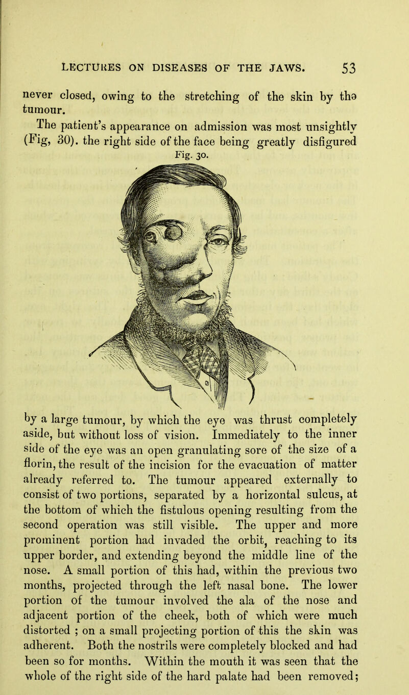 never closed, owing to the stretching of the skin by tha tumour. The patient's appearance on admission was most unsightly (Fig, 30). the right side of the face being greatly disfigured Fig. 30. by a large tumour, by which the eye w^as thrust completely aside, but without loss of vision. Immediately to the inner side of the eye was an open granulating sore of the size of a florin, the result of the incision for the evacuation of matter already referred to. The tumour appeared externally to consist of two portions, separated by a horizontal sulcus, at the bottom of which the fistulous opening resulting from the second operation was still visible. The upper and more prominent portion had invaded the orbit, reaching to its upper border, and extending beyond the middle line of the nose. A small portion of this had, within the previous two months, projected through the left nasal bone. The lower portion of the tumoar involved the ala of the nose and adjacent portion of the cheek, both of which were much distorted ; on a small projecting portion of this the skin was adherent. Both the nostrils were completely blocked and had been so for months. Within the mouth it was seen that the whole of the right side of the hard palate had been removed;