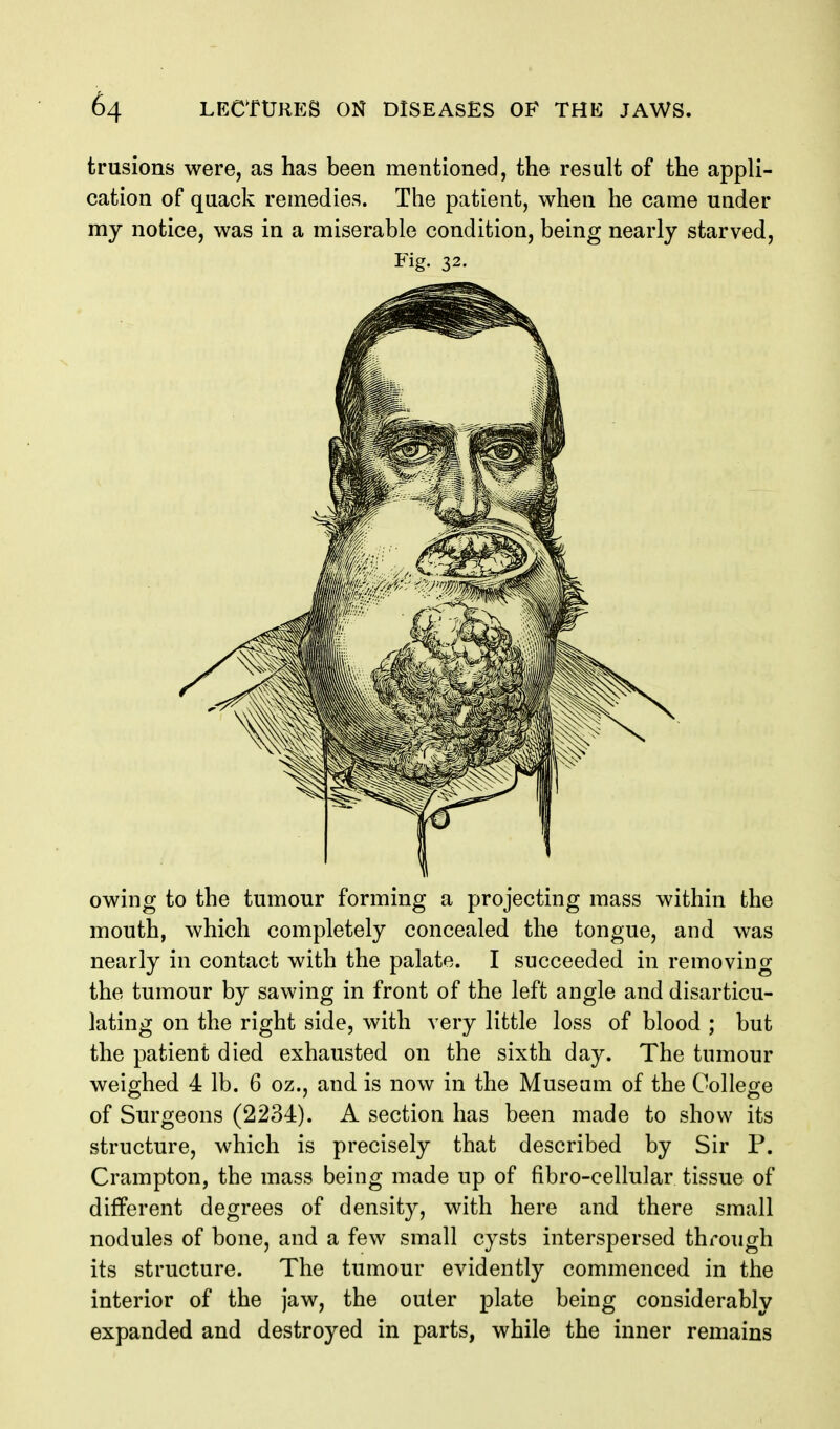 trusions were, as has been mentioned, the result of the appli- cation of quack remedies. The patient, when he came under my notice, was in a miserable condition, being nearly starved. Fig. 32. owing to the tumour forming a projecting mass within the mouth, which completely concealed the tongue, and was nearly in contact with the palate. I succeeded in removing the tumour by sawing in front of the left angle and disarticu- lating on the right side, with very little loss of blood ; but the patient died exhausted on the sixth day. The tumour weighed 4 lb. 6 oz., and is now in the Museum of the Oollese of Surgeons (2234). A section has been made to show its structure, which is precisely that described by Sir P. Crampton, the mass being made up of fibro-cellular tissue of different degrees of density, with here and there small nodules of bone, and a few small cysts interspersed through its structure. The tumour evidently commenced in the interior of the jaw, the outer plate being considerably expanded and destroyed in parts, while the inner remains