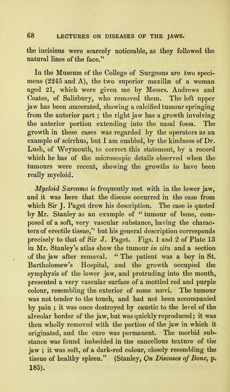 the incisions were scarcely noticeable, as they followed the natural lines of the face. In the Museum of the College of Surgeons are two speci- mens (2245 and A), the two superior maxillae of a woman aged 2l, which were given me by Messrs. Andrews and Ooates, of Salisbury, who removed them. The left upper jaw has been macerated, showing a calcified tumour springing from the anterior part ; the right jaw has a growth involving the anterior portion extending into the nasal fossa. The growth in these cases was regarded by the operators as an example of scirrhus, but I am enabled, by the kindness of Dr. Lush, of Weymouth, to correct this statement, by a record which he has of the microscopic details observed when the tumours were recent, showing the growths to have been really myeloid. Myeloid Sarcoma is frequently met with in the lower jaw, and it was here that the disease occurred in the case from which Sir J. Paget drew his description. The case is quoted by Mr. Stanley as an example of  tumour of bone, com- posed of a soft, very vascular substance, having the charac- ters of erectile tissue, but his general description corresponds precisely to that of Sir J. Paget. Figs. 1 and 2 of Plate 13 in Mr. Stanley's atlas show the tumour in situ and a section of the jaw after removal.  The patient was a boy in St. Bartholomew's Hospital, and the growth occupied the symphysis of the lower jaw, and protruding into the mouth, presented a very vascular surface of a mottled red and purple colour, resembling the exterior of some nsevi. The tumour was not tender to the touch, and had not been accompanied by pain ; it was once destroyed by caustic to the level of the alveolar border of the jaw, but was quickly reproduced; it was then wholly removed with the portion of the jaw in which it originated, and the cure was permanent. The morbid sub- stance was found imbedded in the cancellous texture of the jaw ; it was soft, of a dark-red colour, closely resembling the tissue of healthy spleen. (Stanley, On Diseases of Bone^ p. 185).